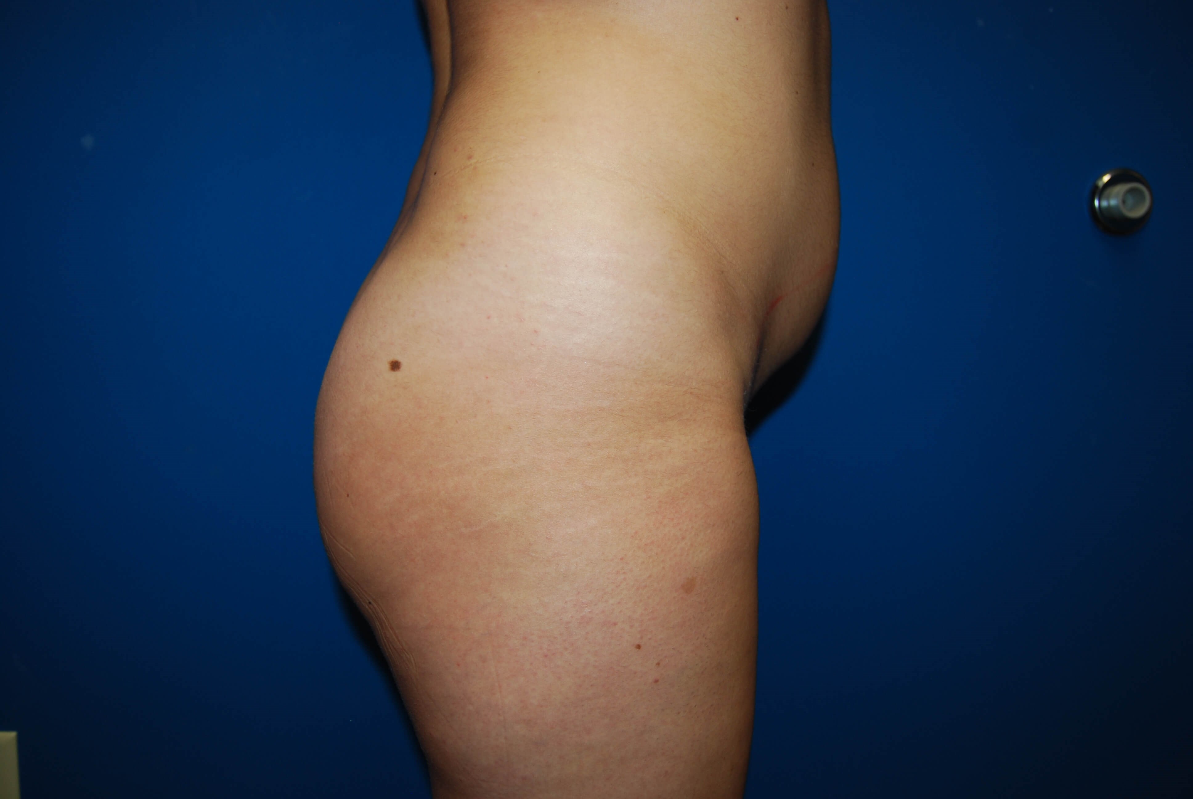 Lateral - Right Before BBL