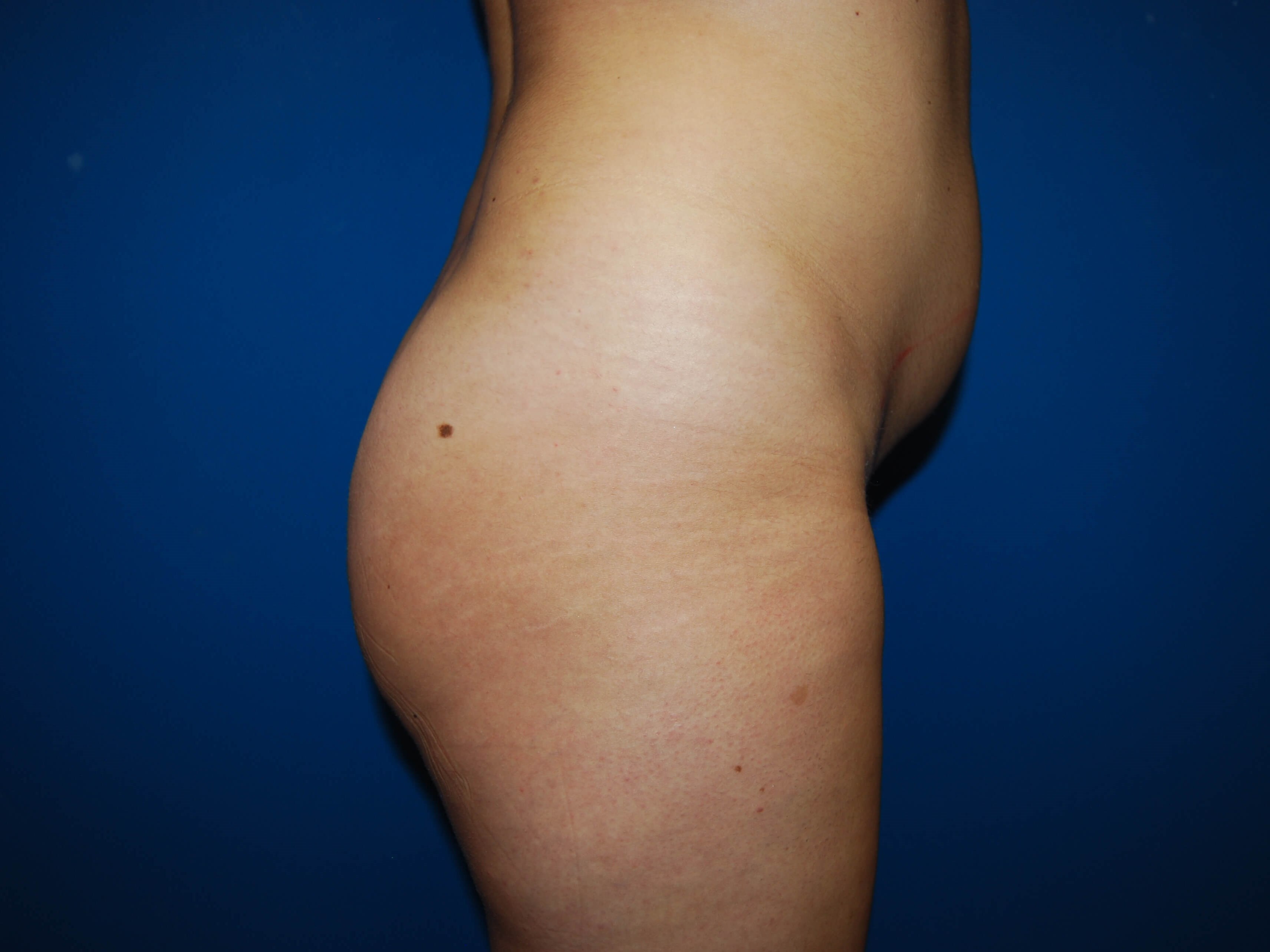 Lateral - Right Before BBL