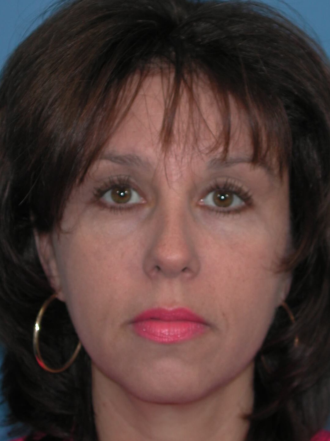 Front After Brow Lift