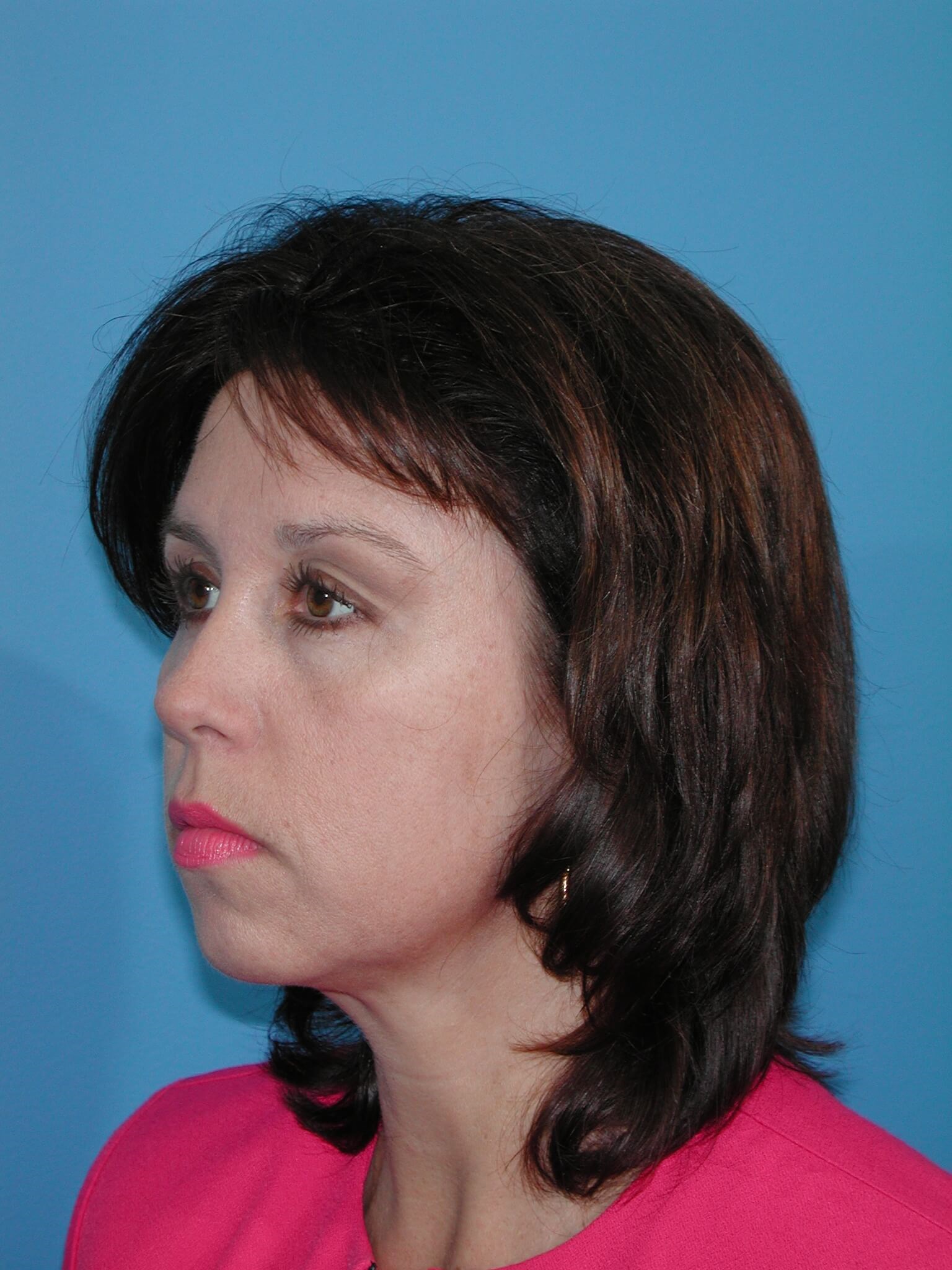 Left Side View After Brow Lift
