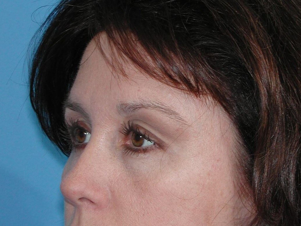 Left Side View After Brow Lift