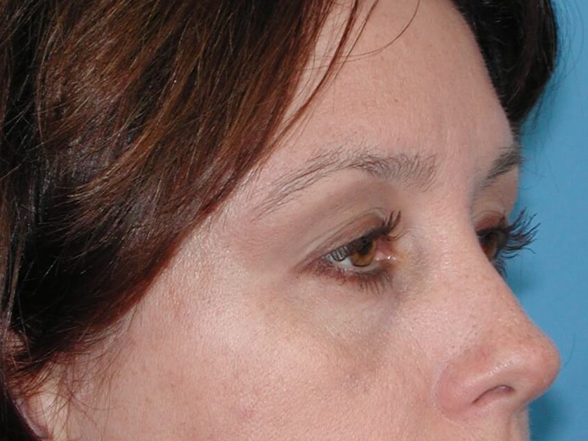 Right Side View After Brow Lift
