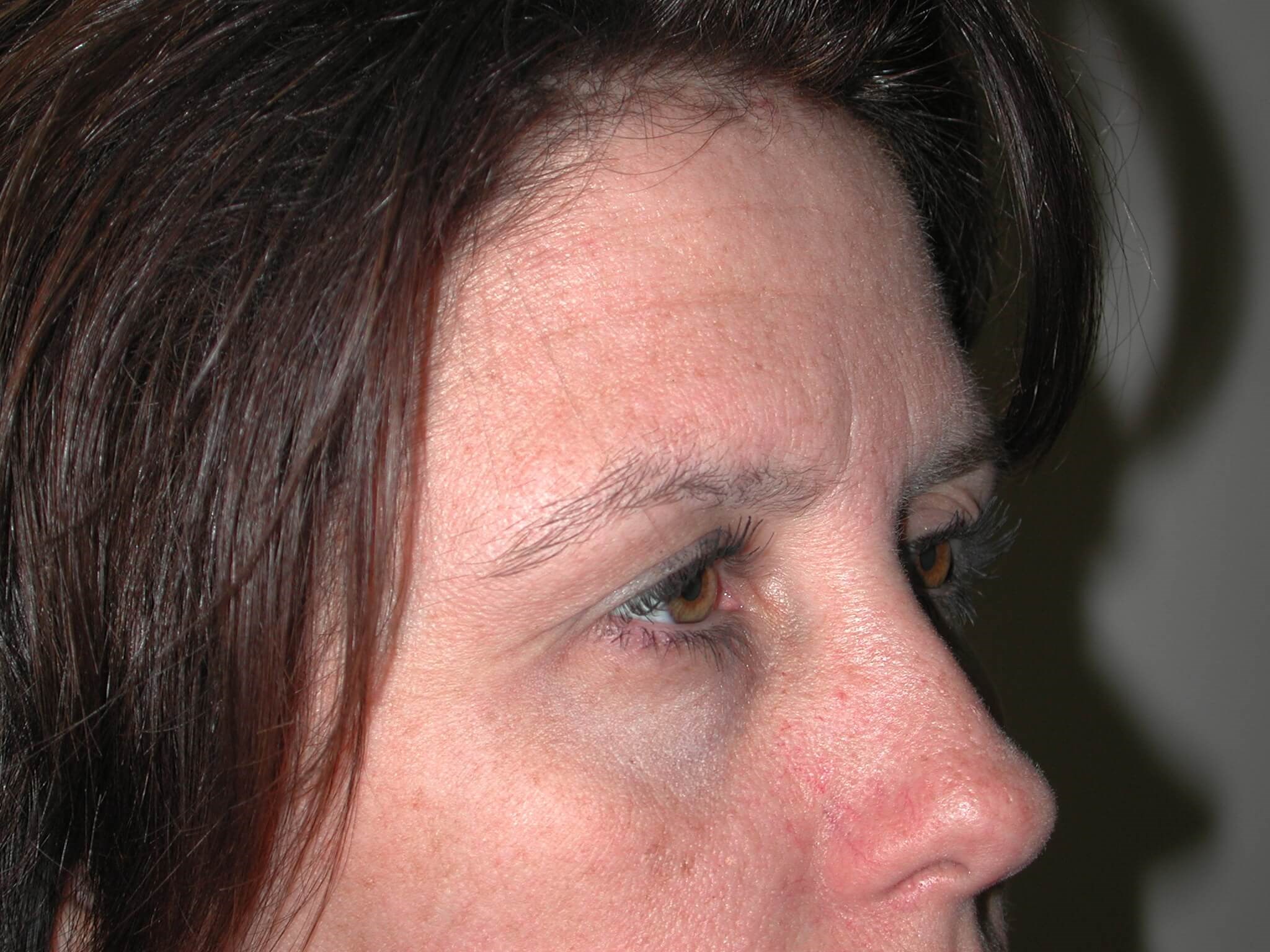 Right Side View Before Brow Lift
