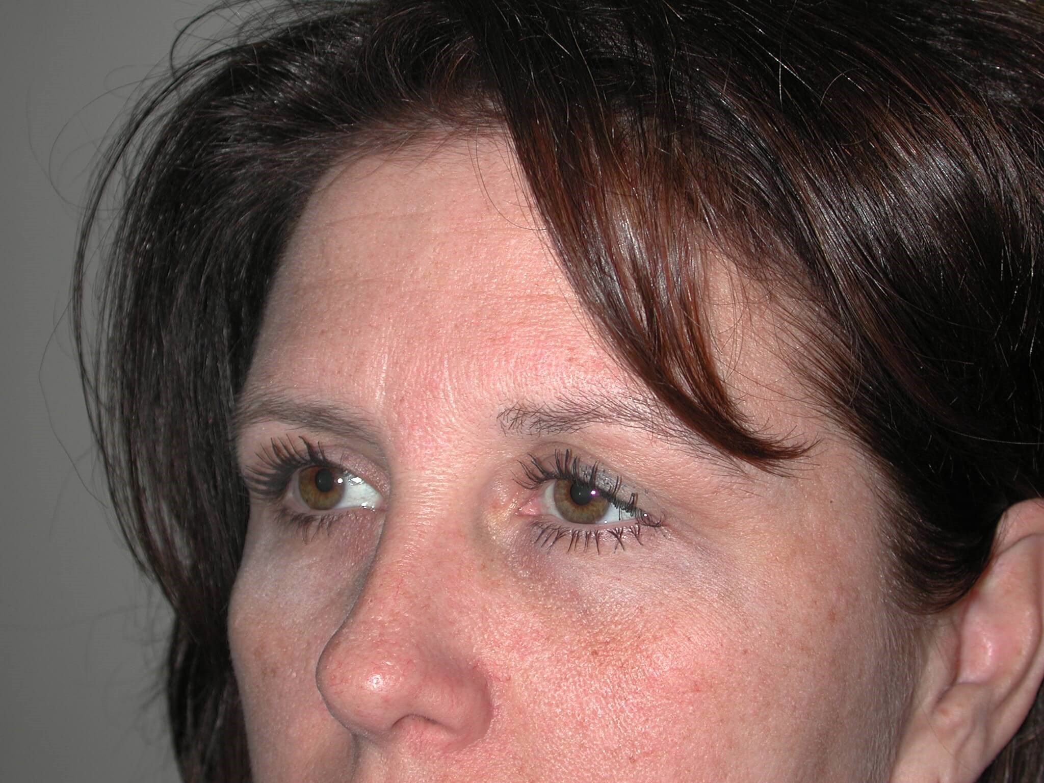 Left Side View Before Brow Lift