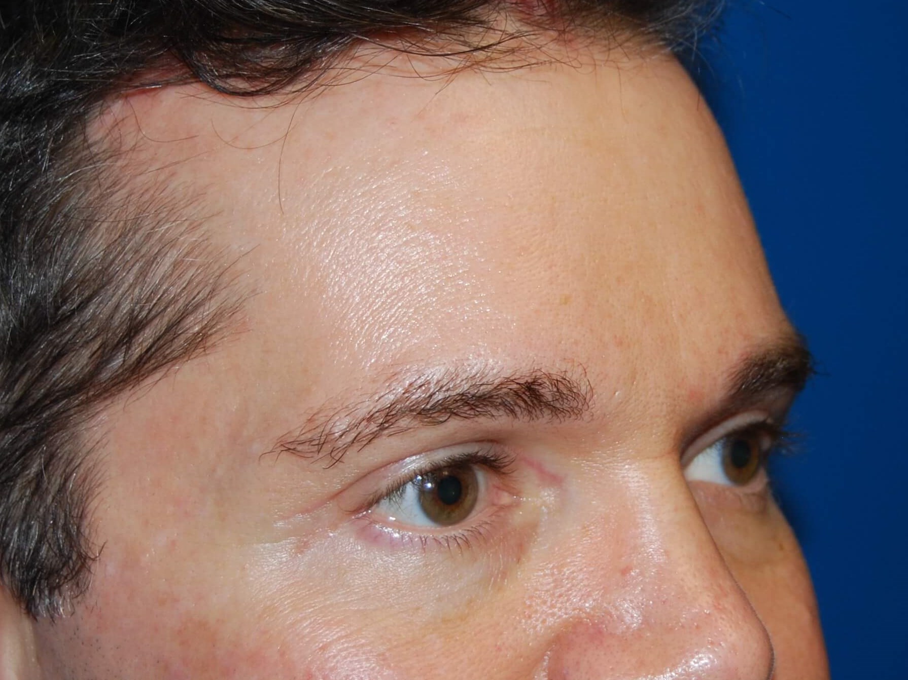 Oblique - Right After