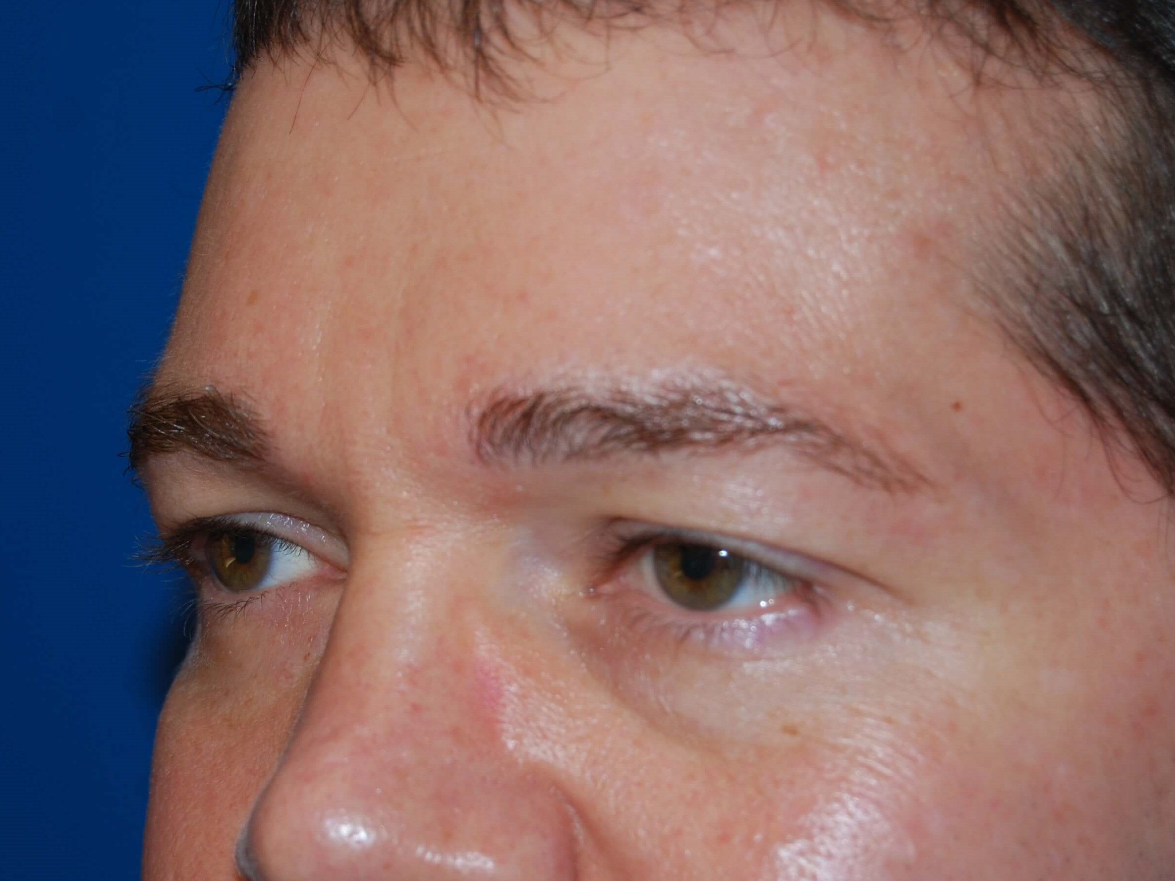 Oblique - Left Before