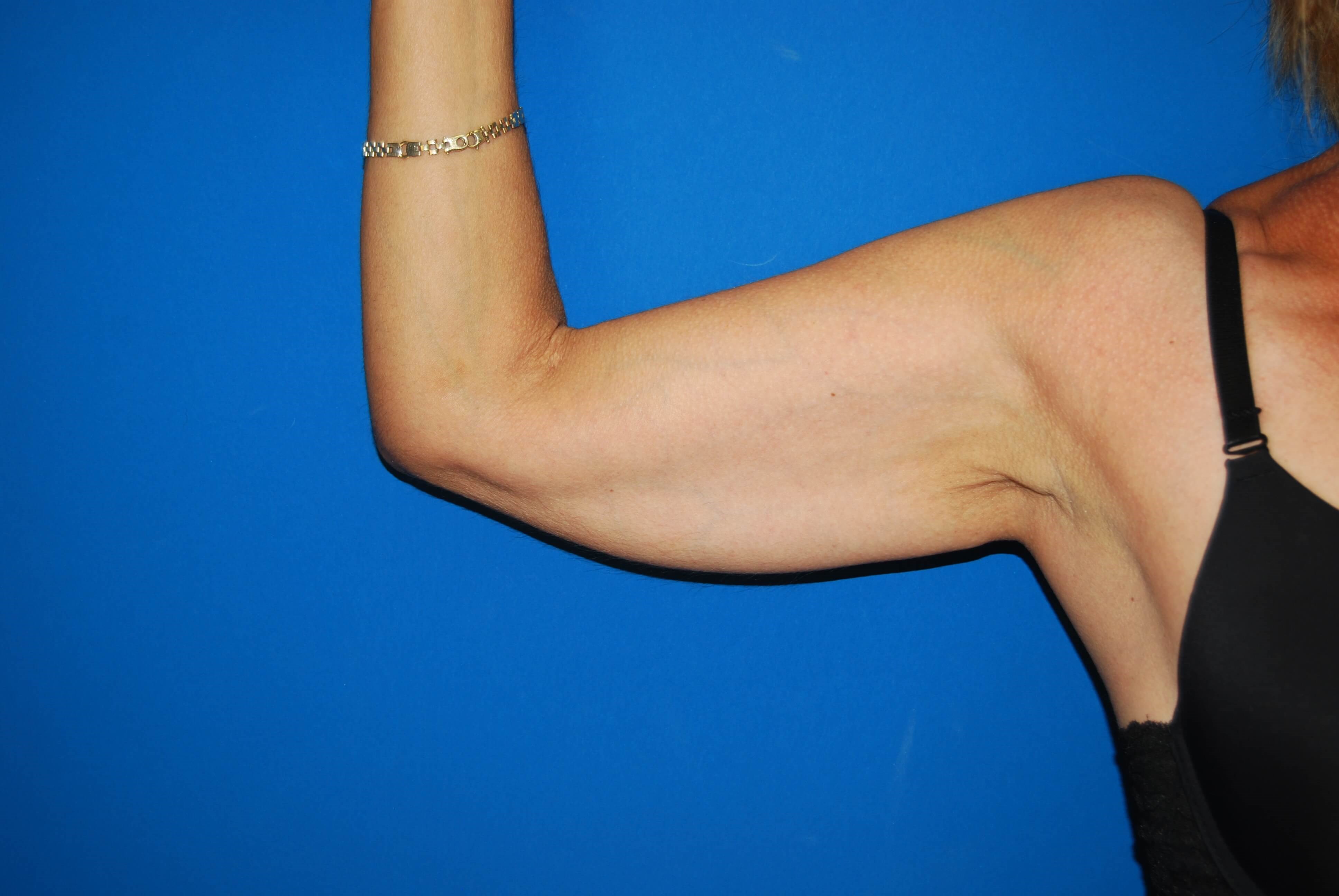 View 1 Before Arm Lift