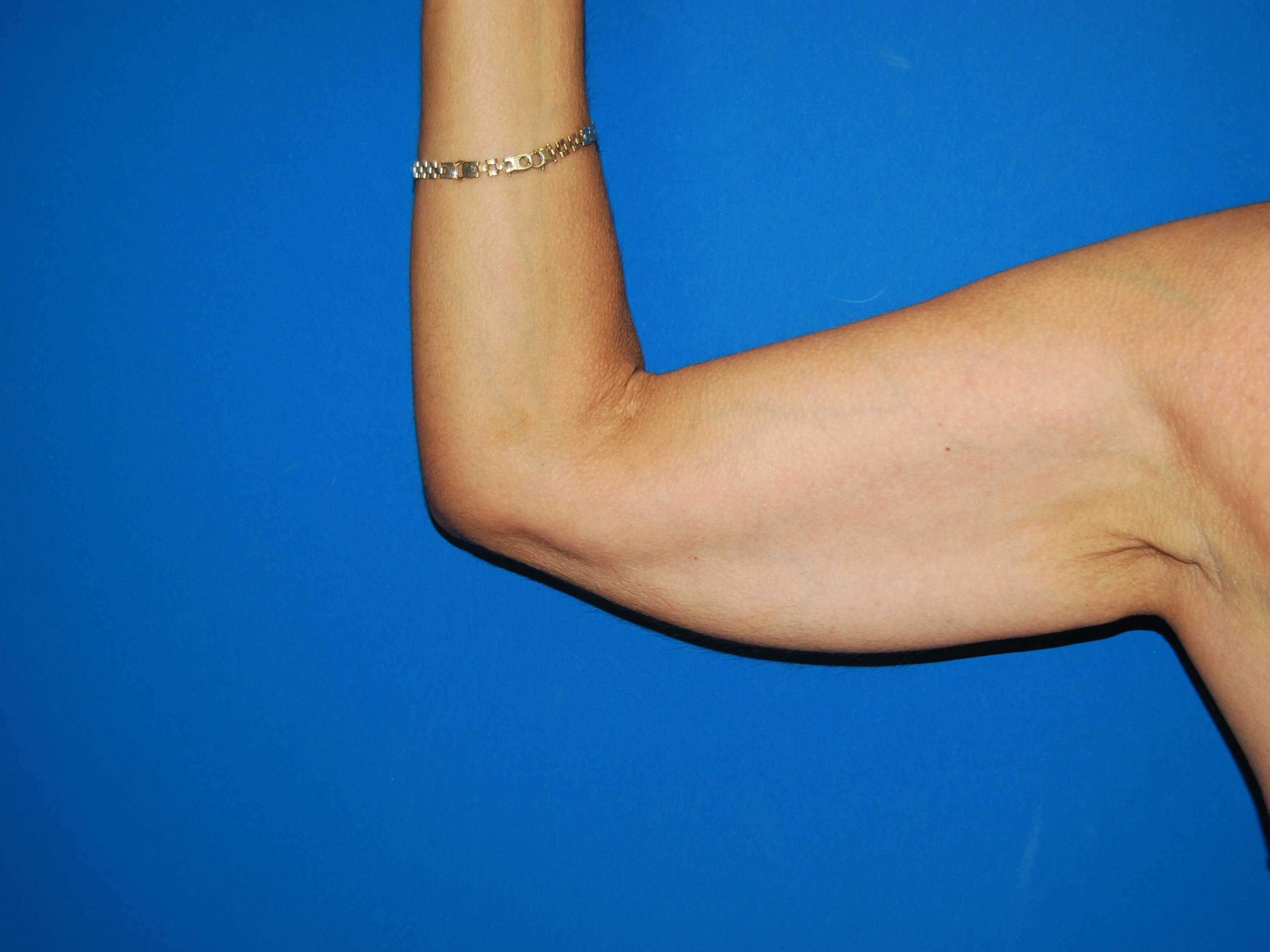 View 1 Before Arm Lift