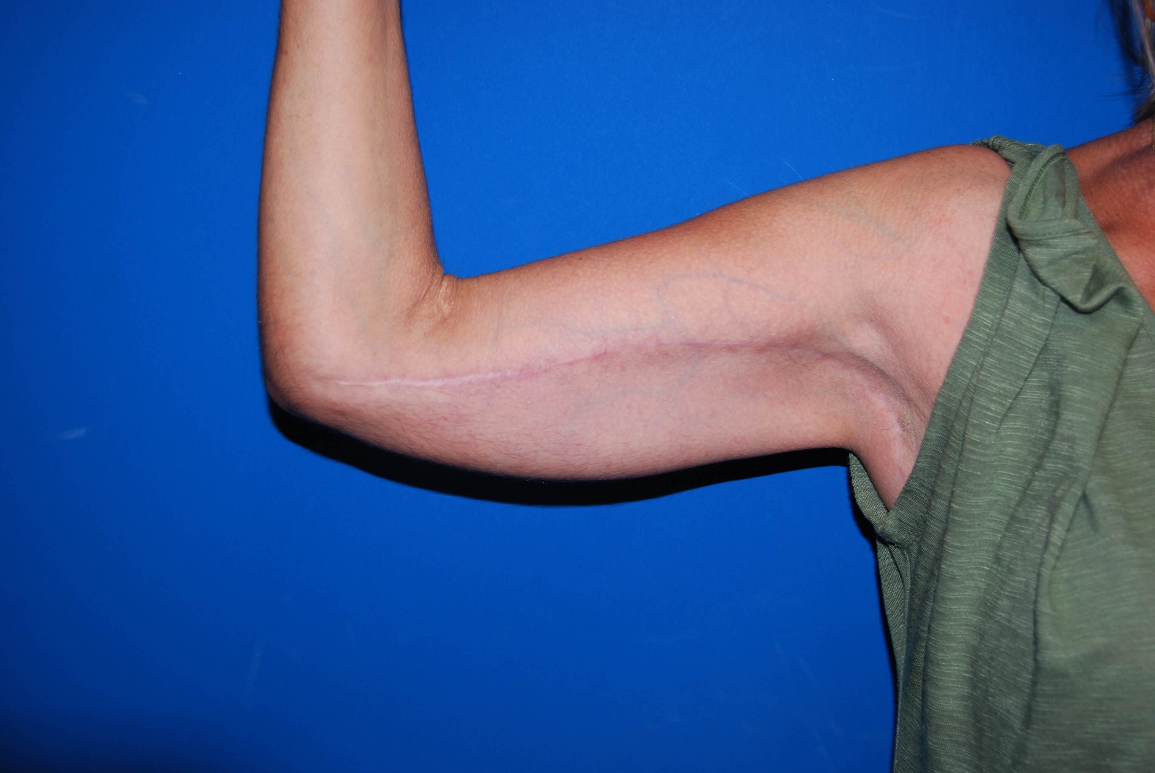 View 1 After Arm Lift