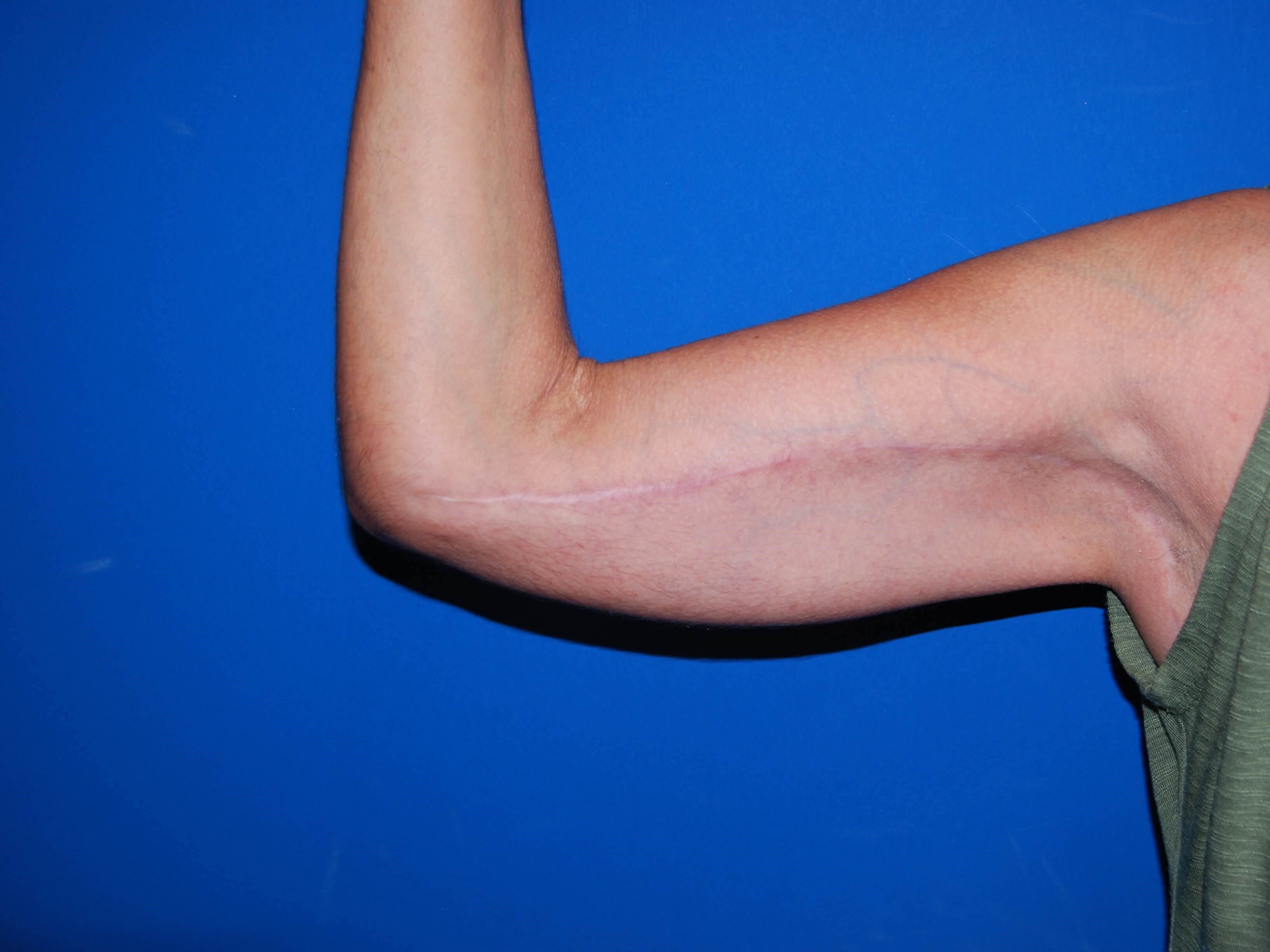View 1 After Arm Lift