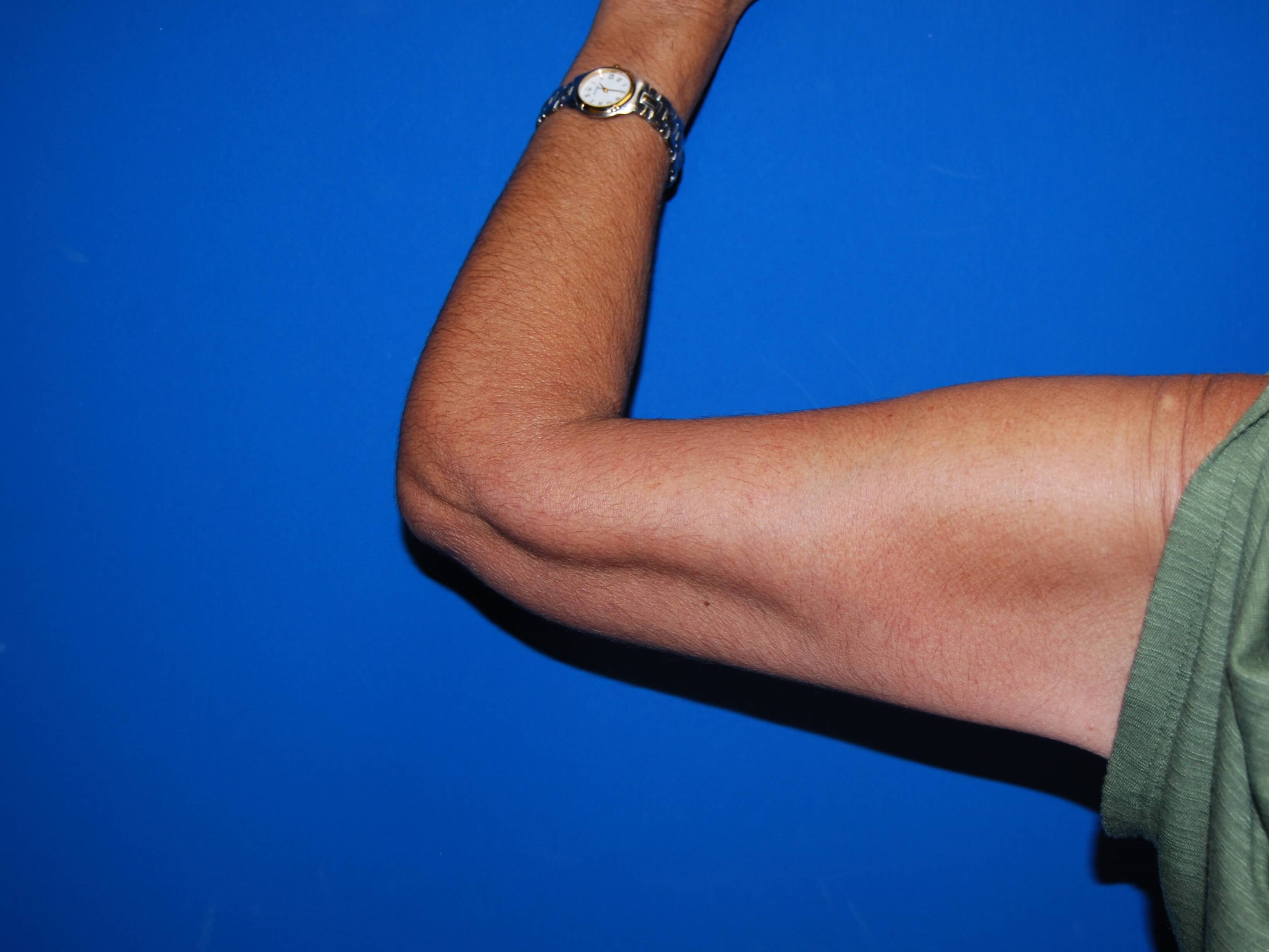 View 2 After Arm Lift