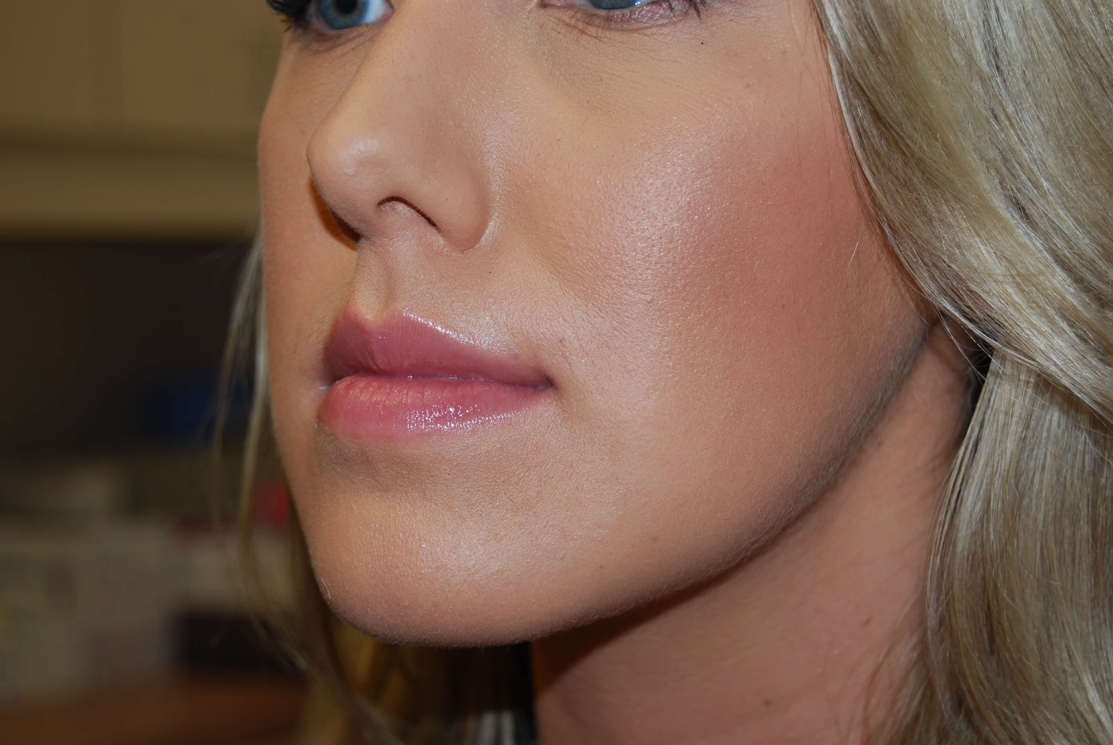Lip Filler Before