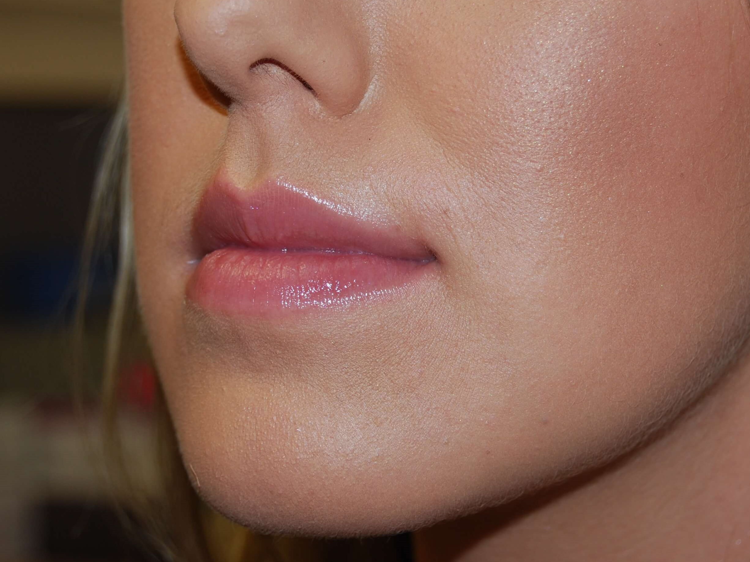 Lip Filler Before