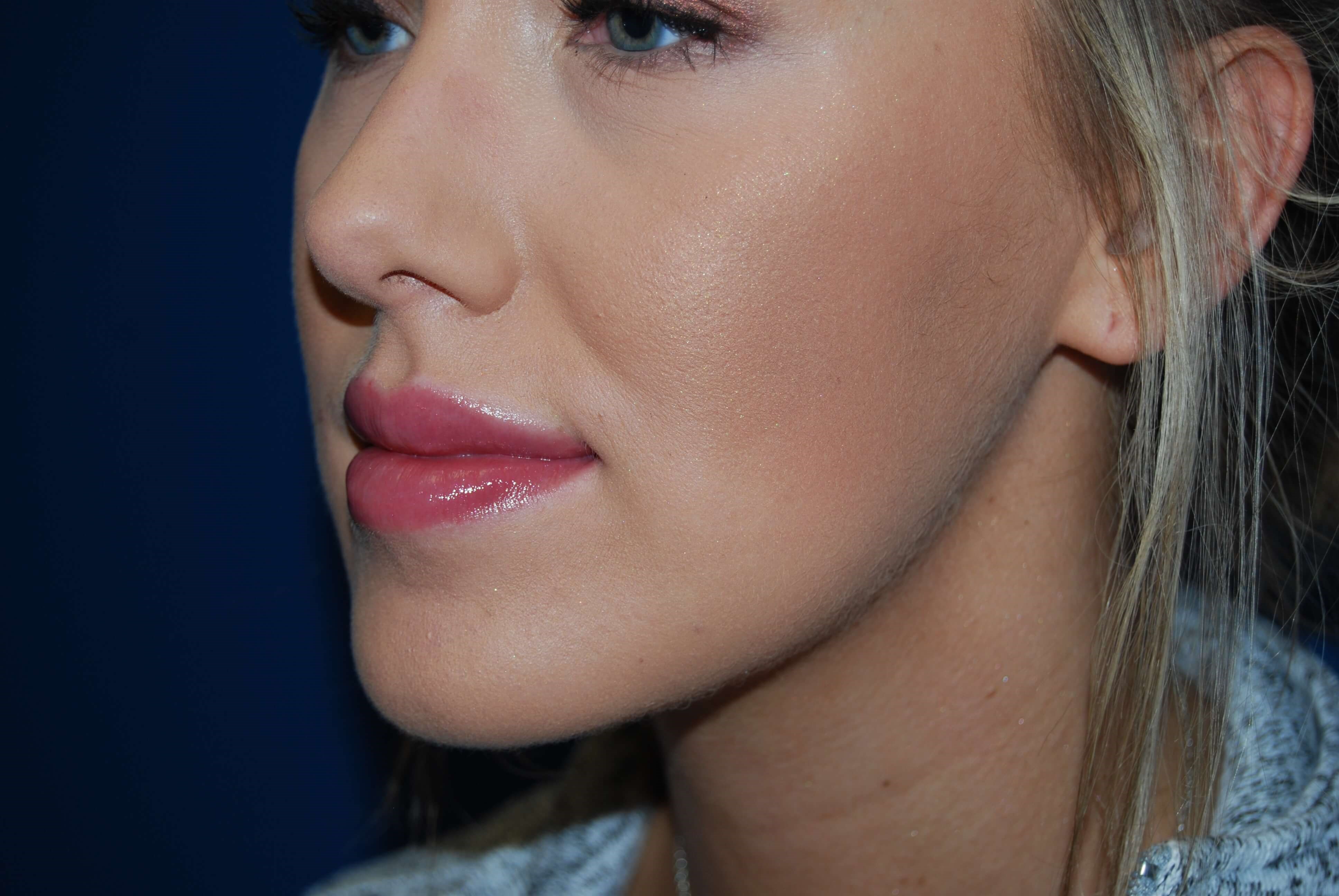 Lip Filler After