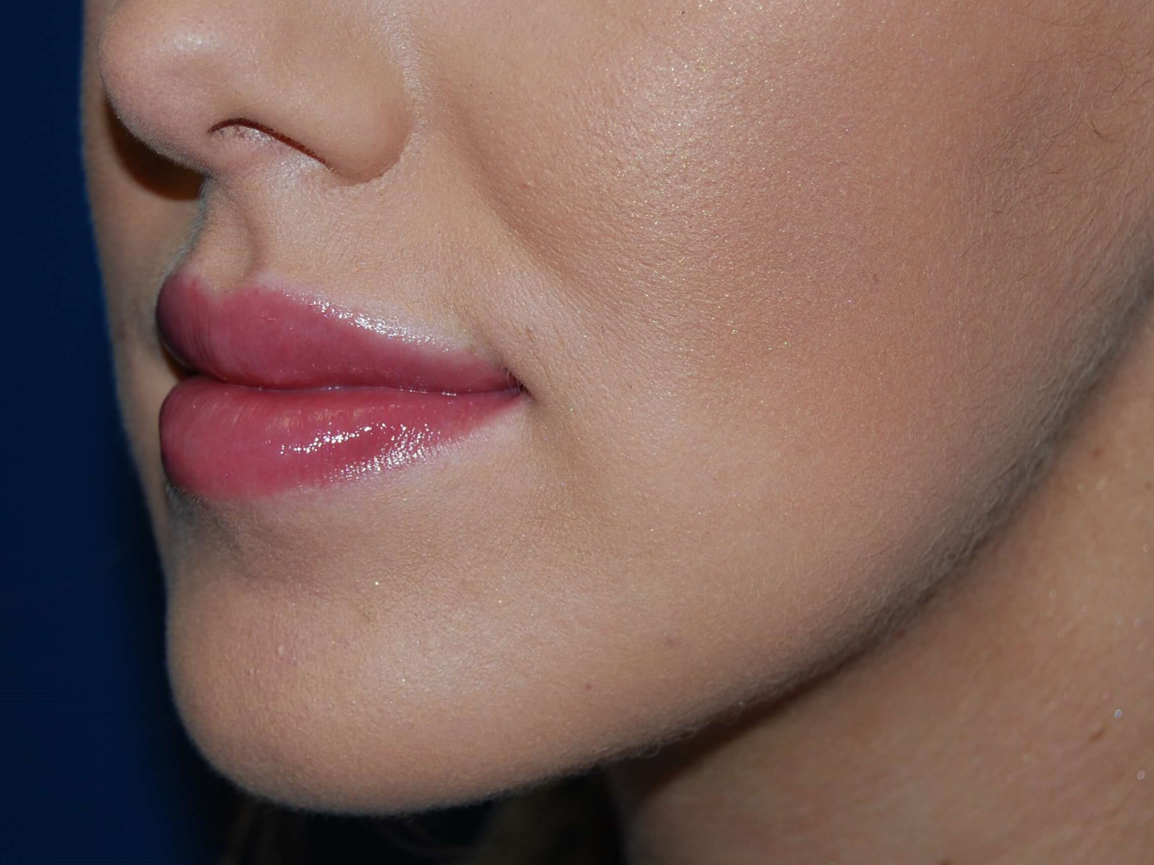 Lip Filler After