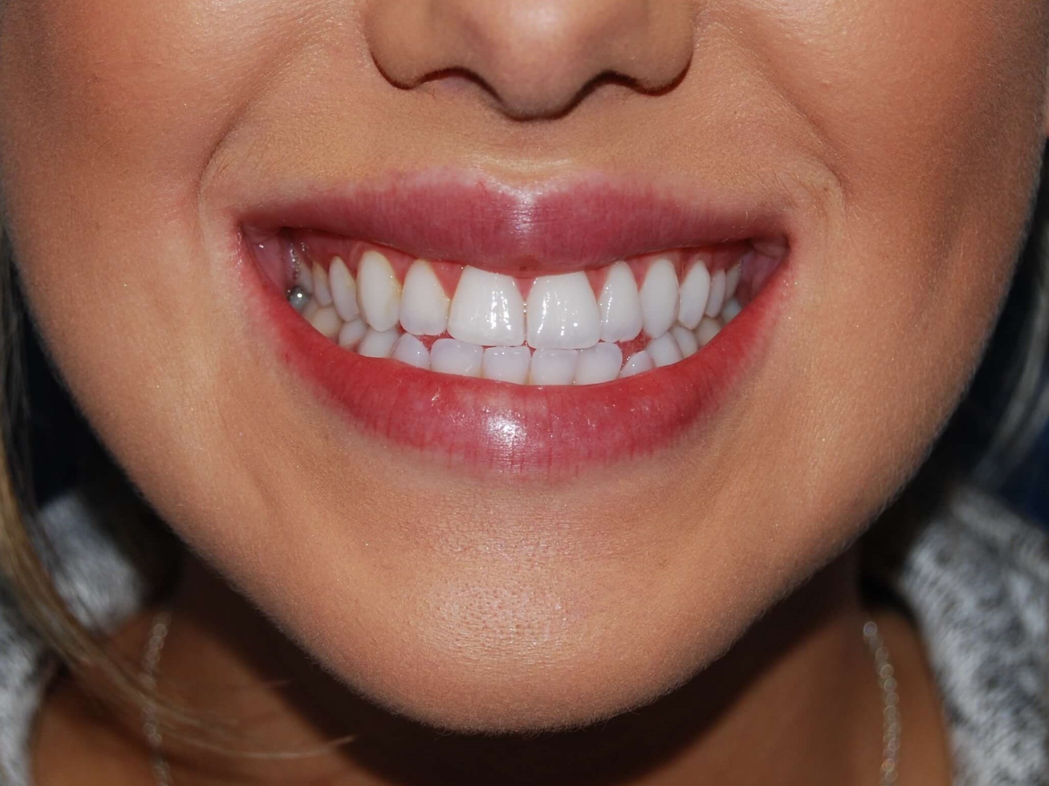 Lip Filler After