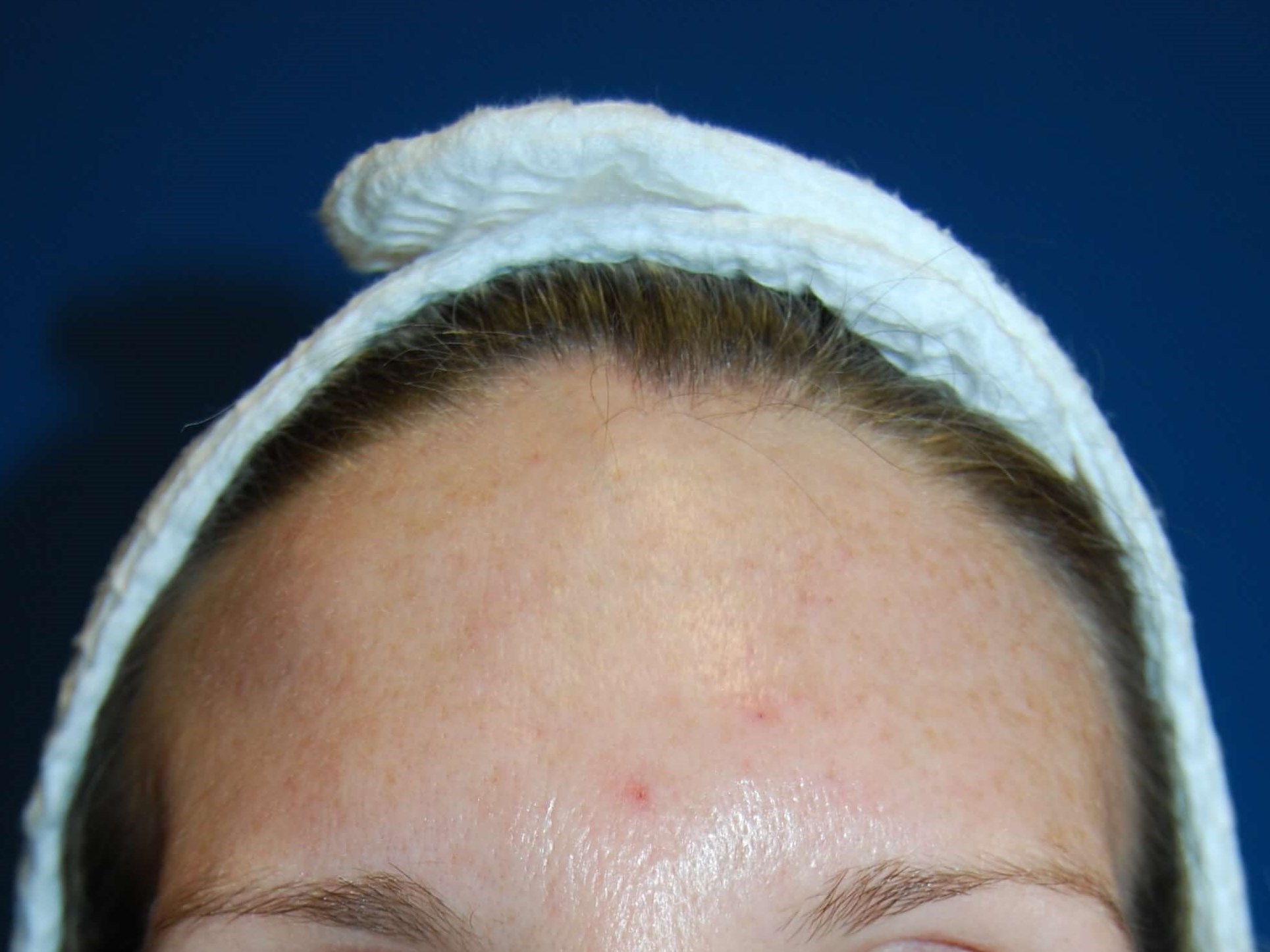 Halo + Broad Band Light (BBL) Before