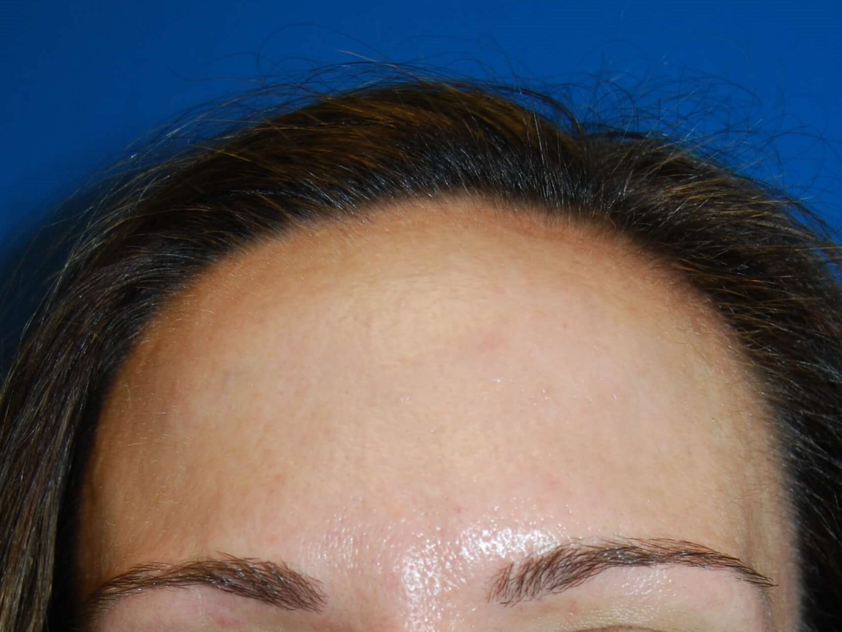Halo + Broad Band Light (BBL) Before