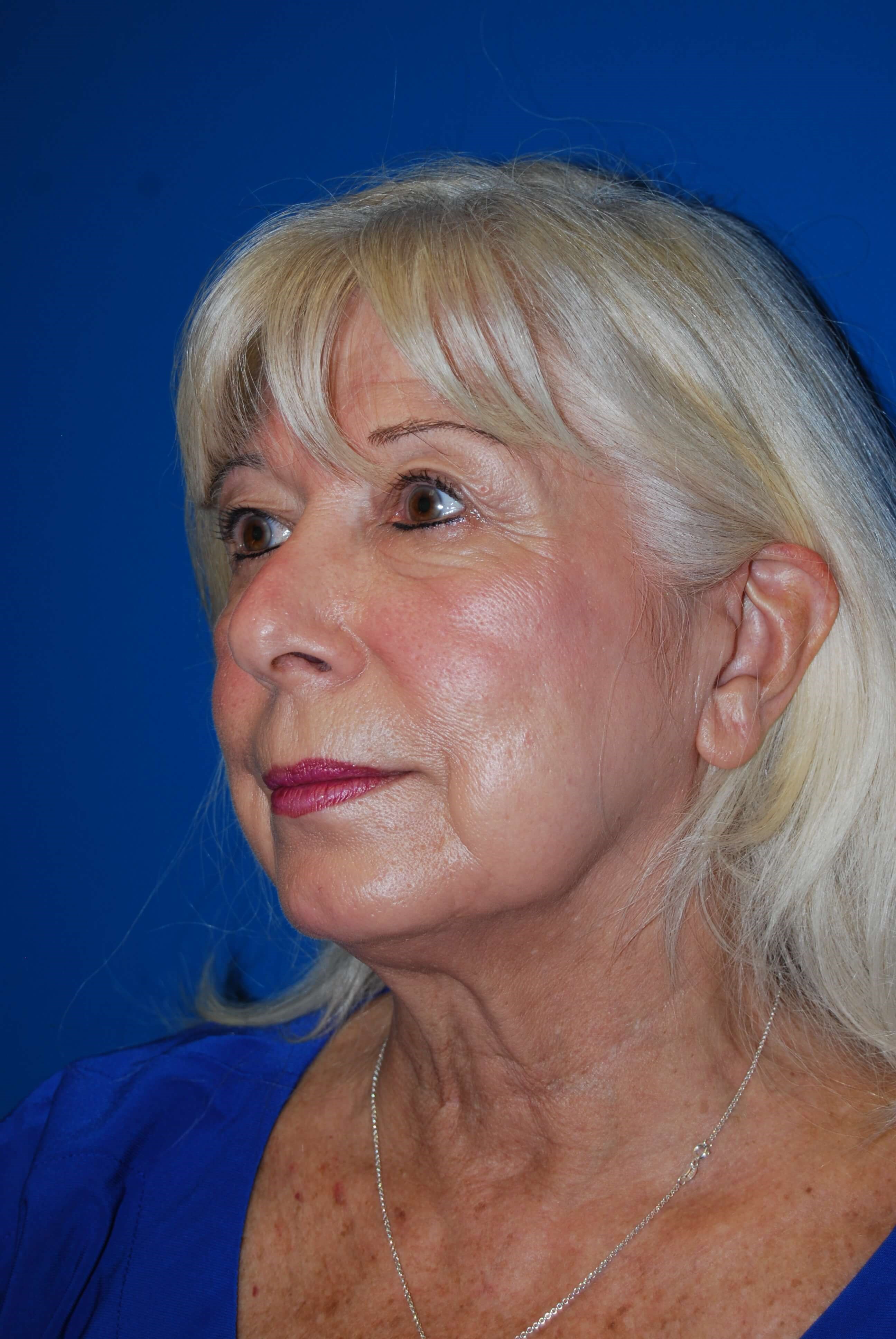 Dermal Fillers Before