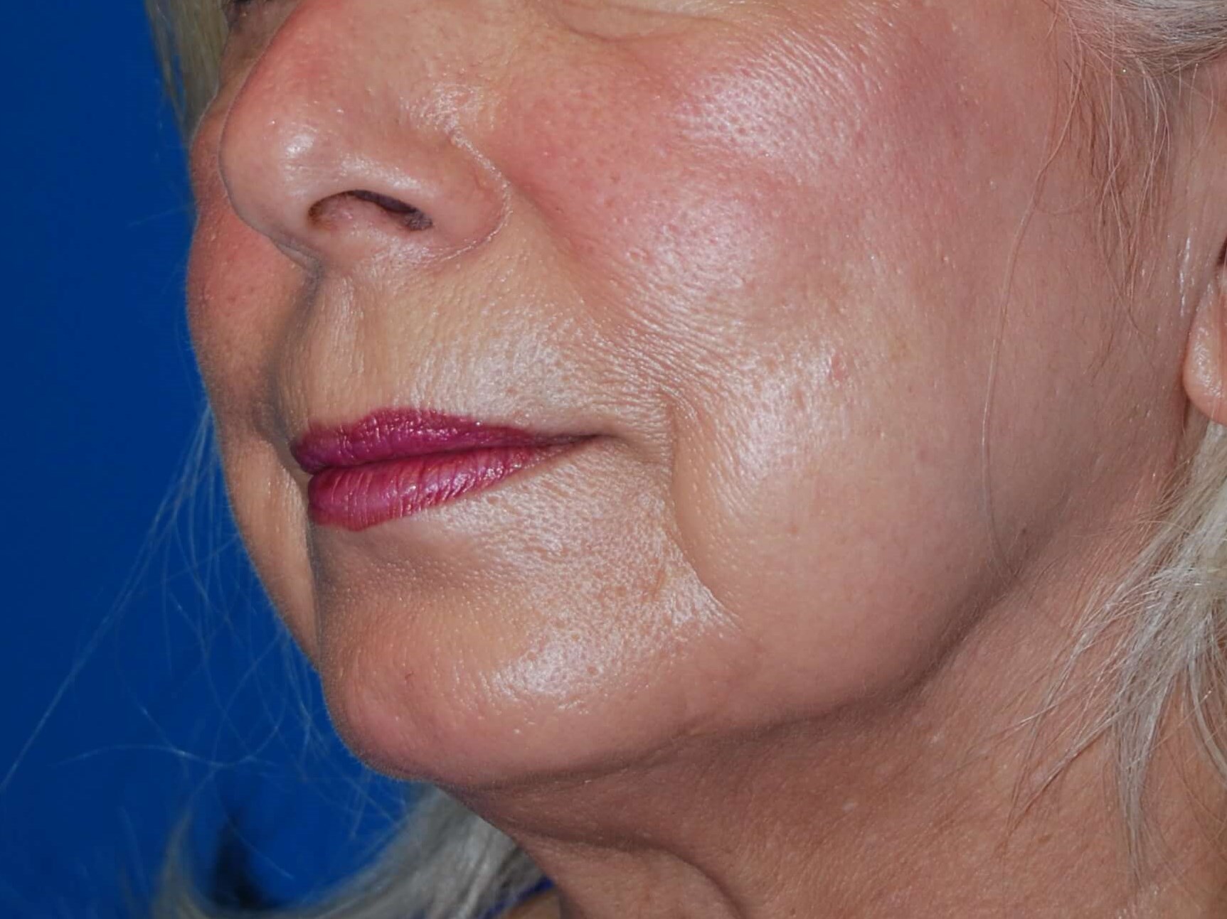Dermal Fillers Before