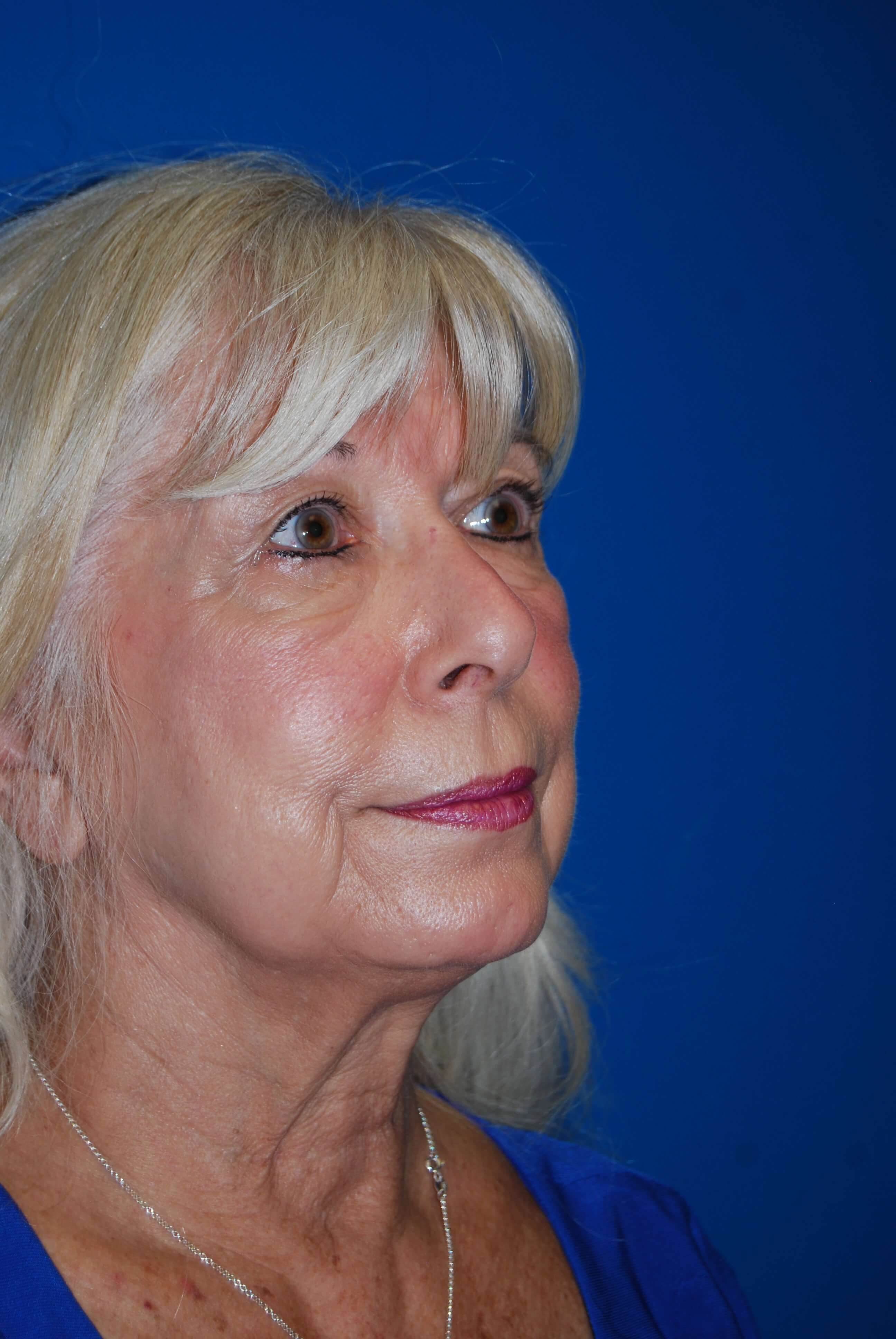 Dermal Fillers Before