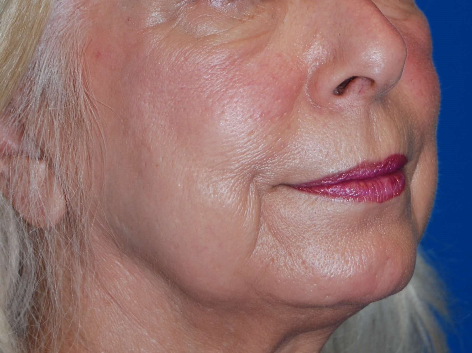 Dermal Fillers Before