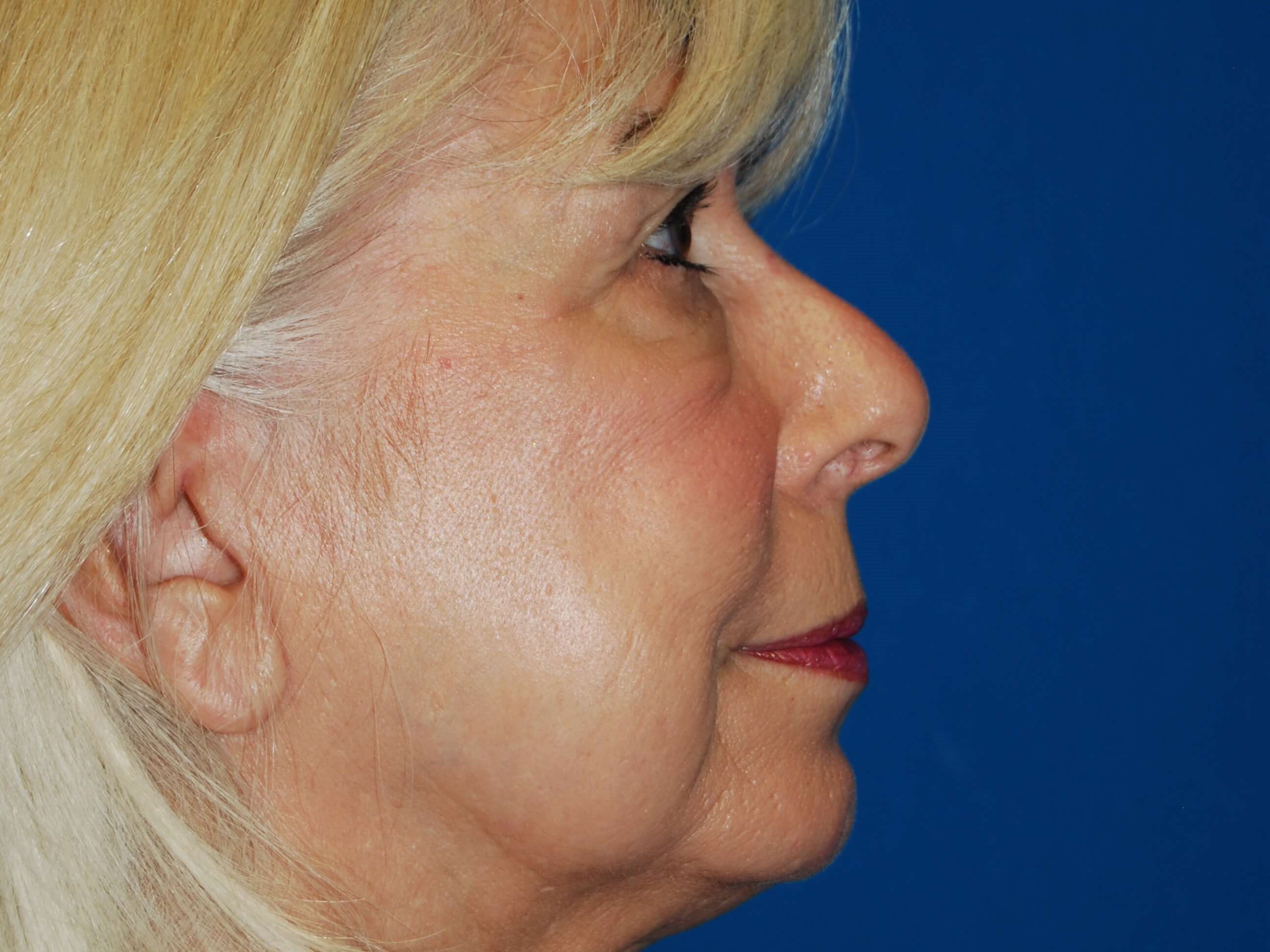 Dermal Fillers Before