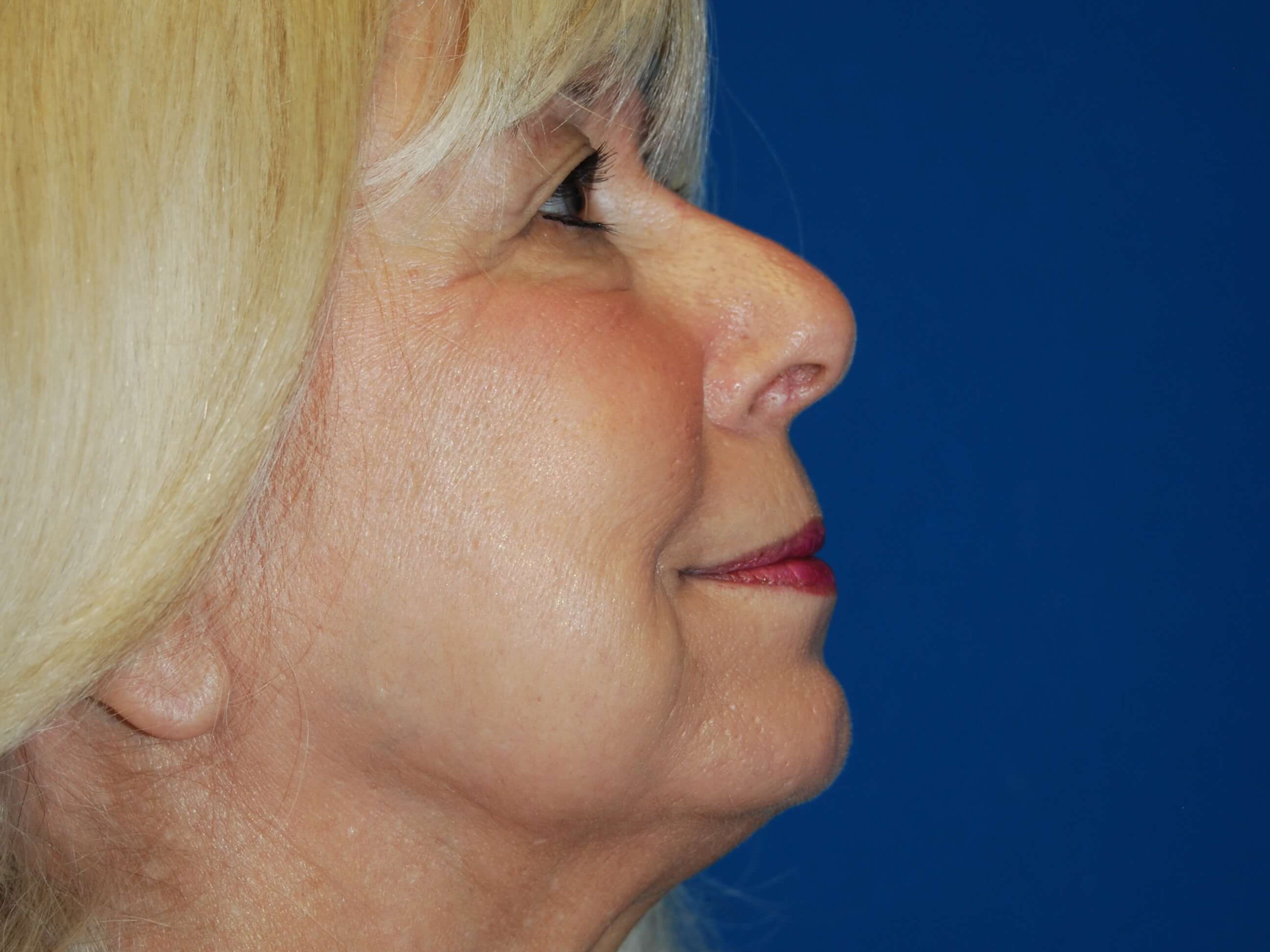 Dermal Fillers After