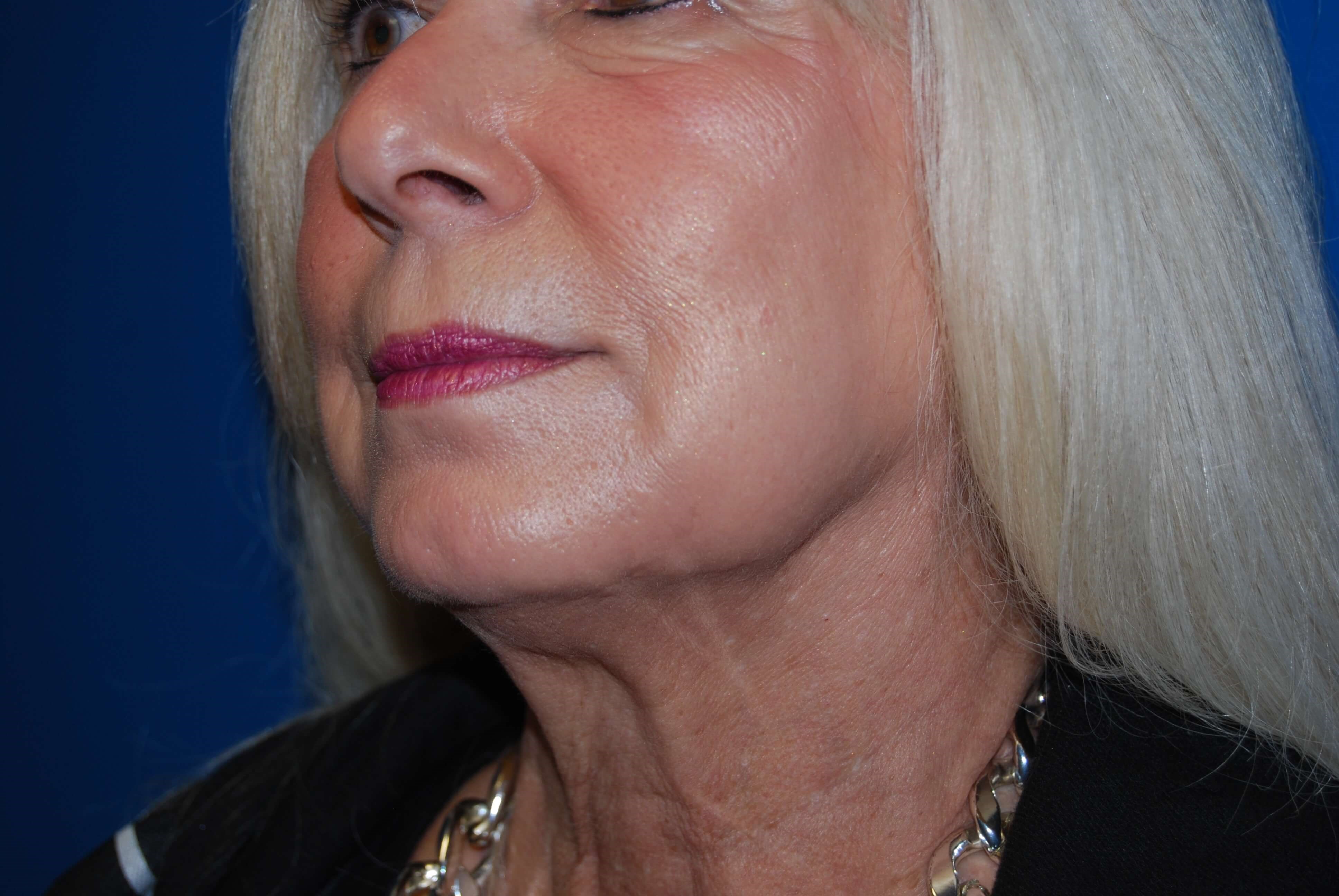 Dermal Fillers After