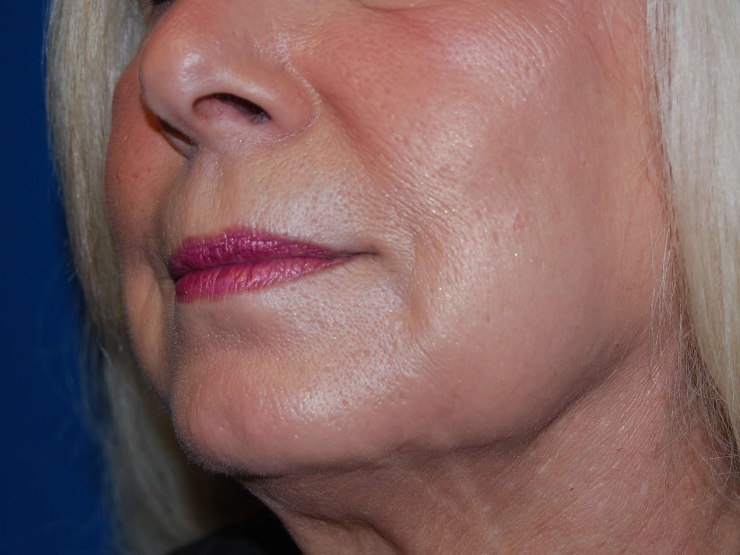 Dermal Fillers After