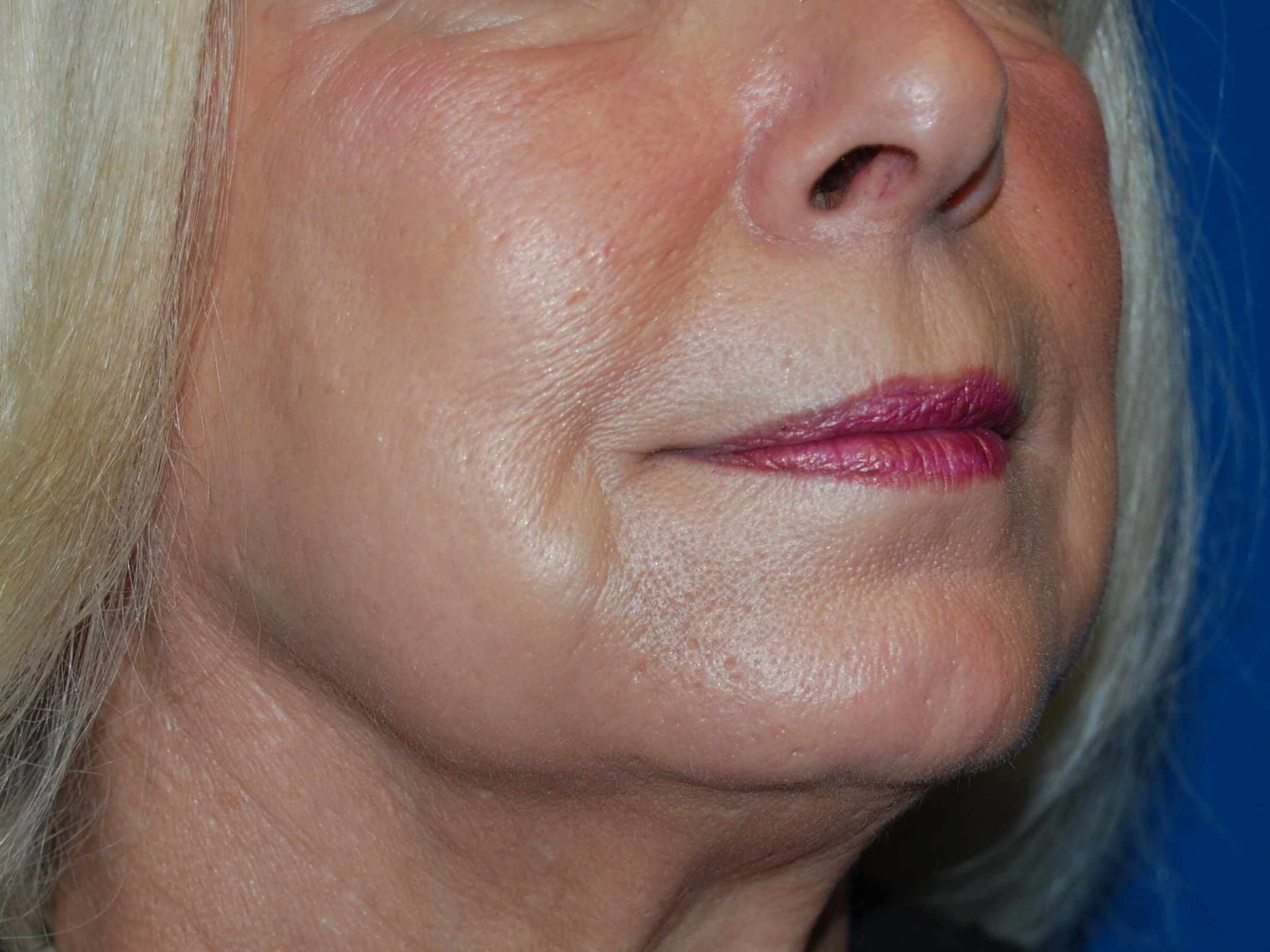 Dermal Fillers After