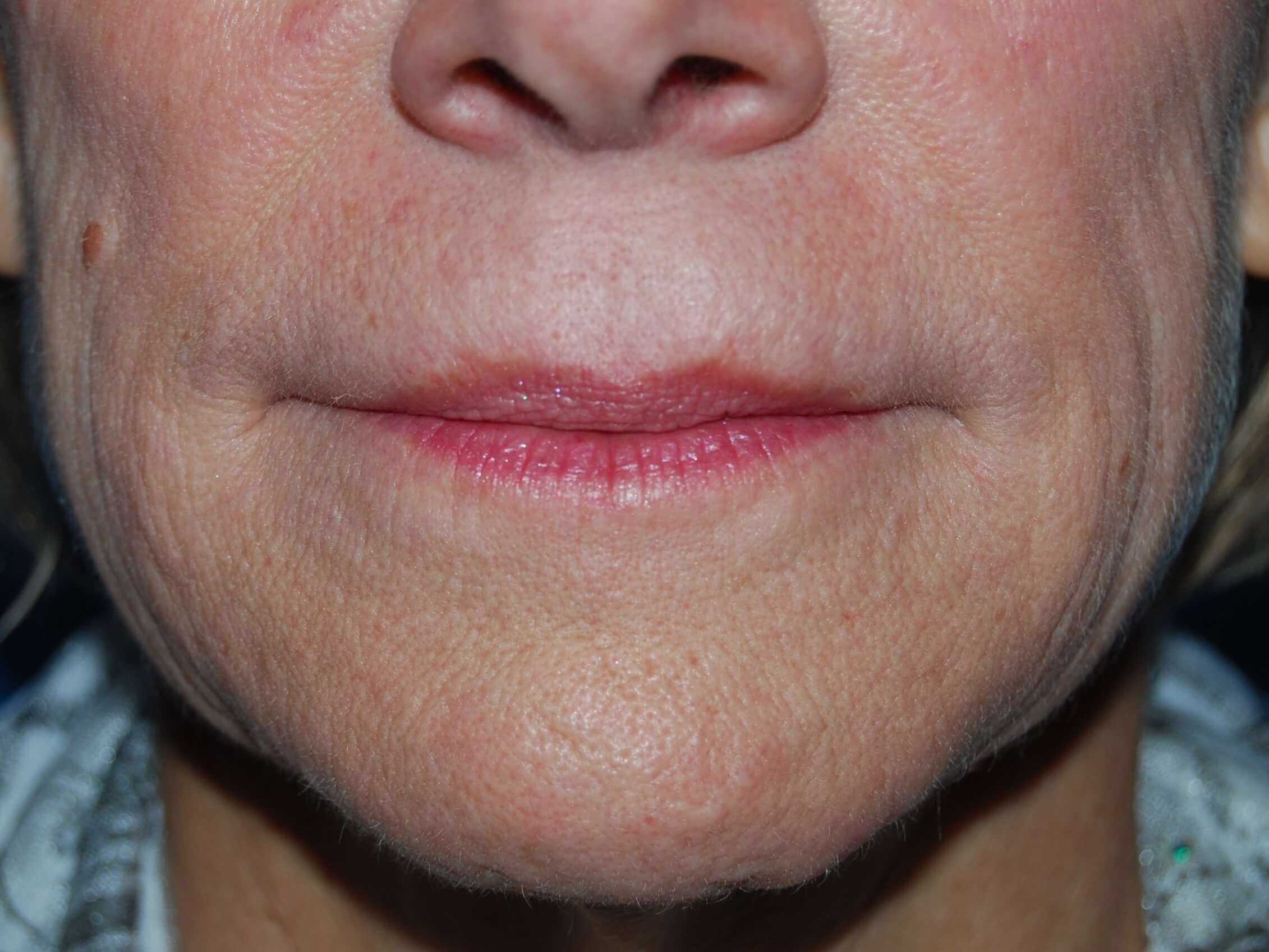 Lip Filler Before