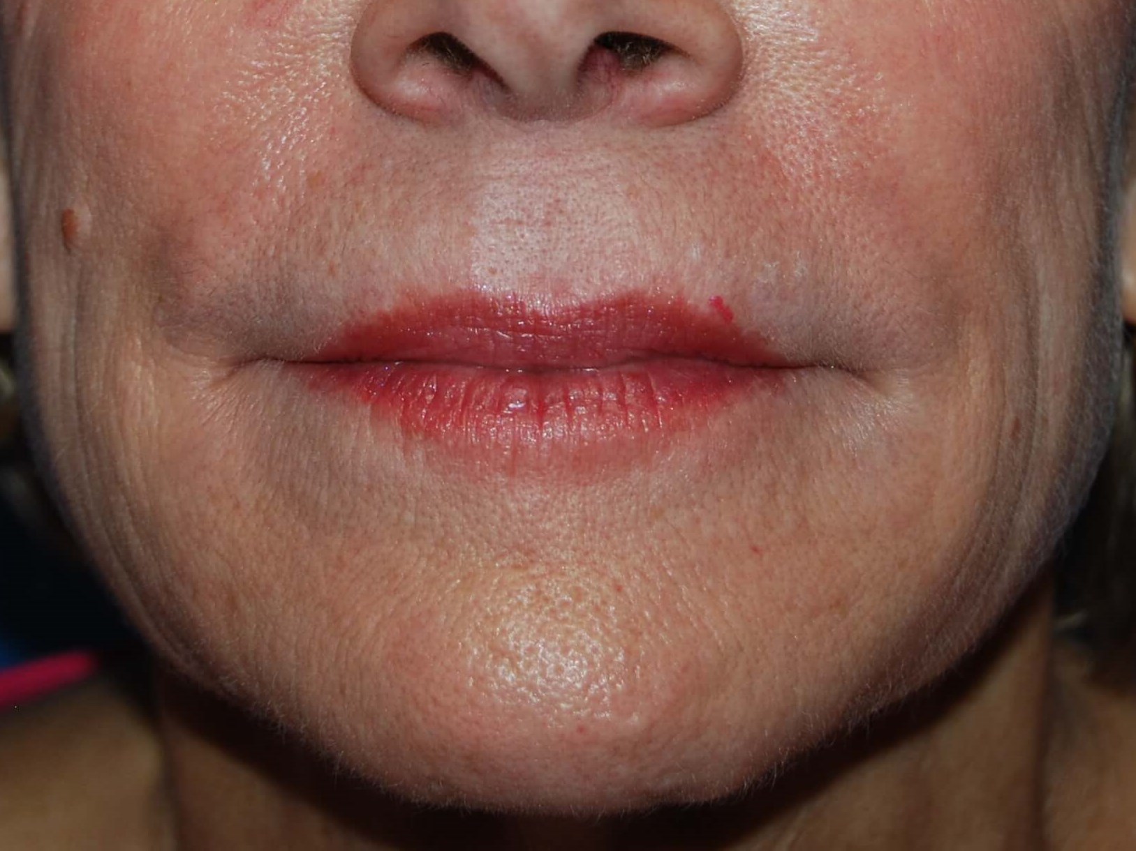 Lip Filler After