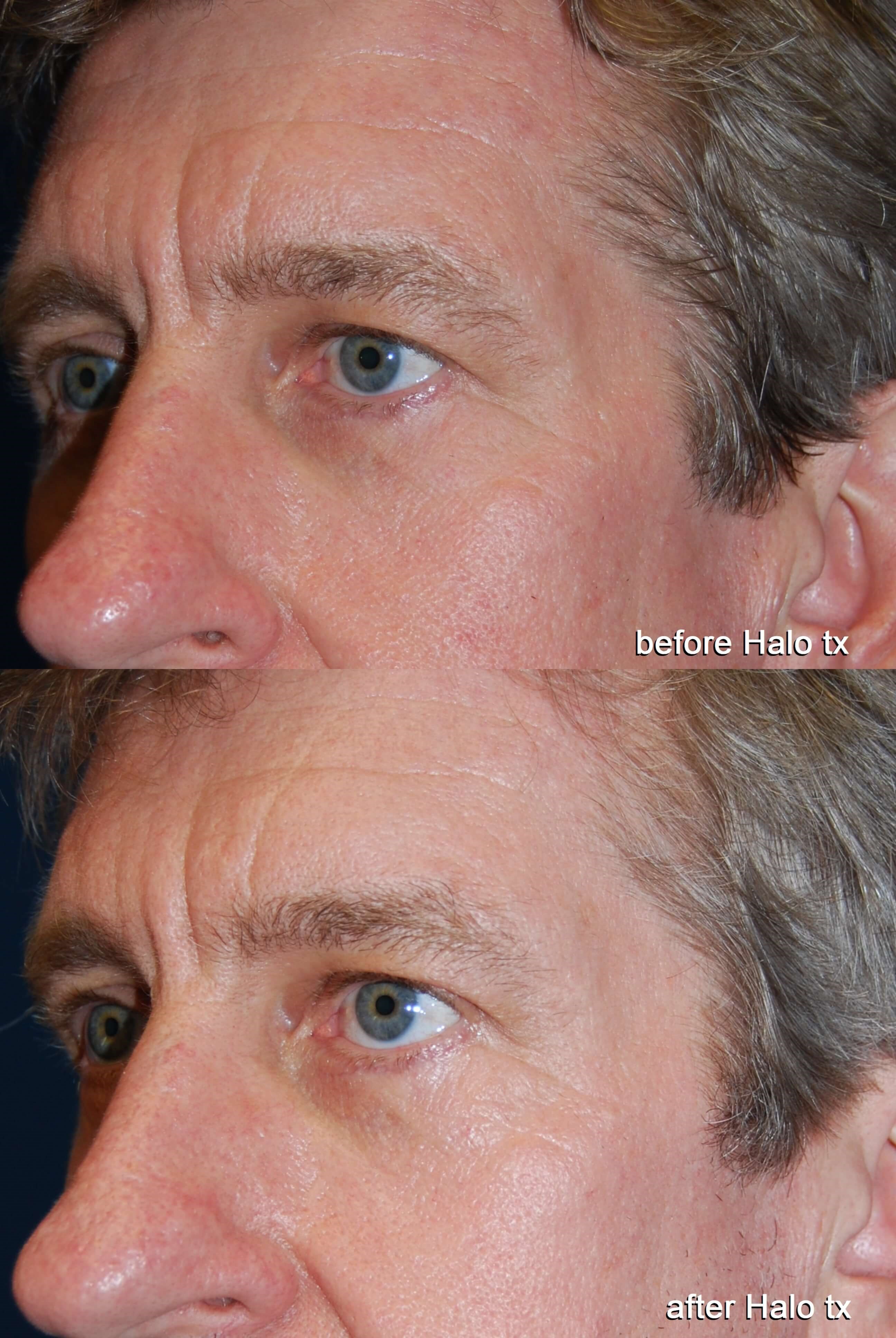 Halo + Broad Band Light (BBL) Before