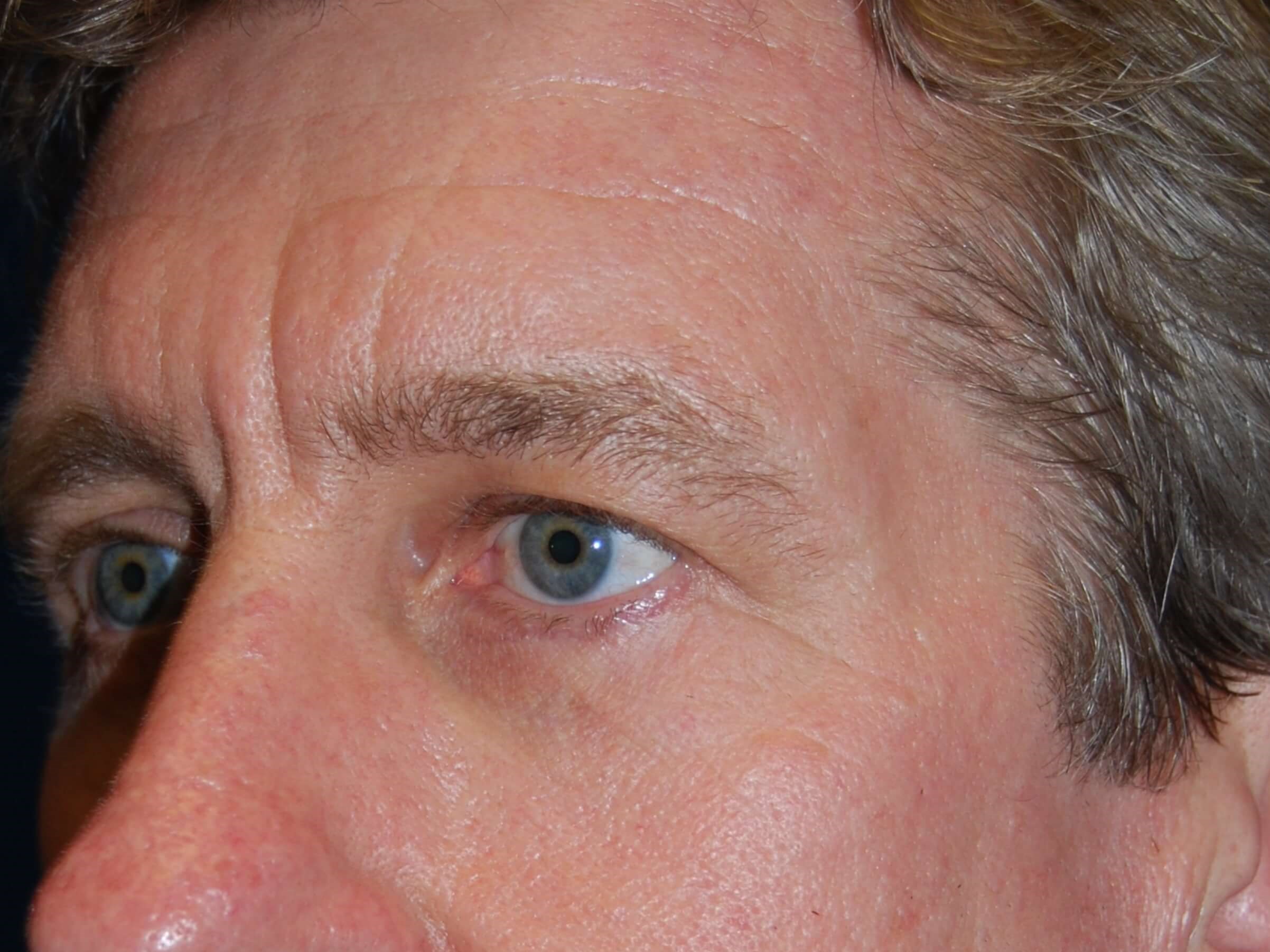 Halo + Broad Band Light (BBL) Before