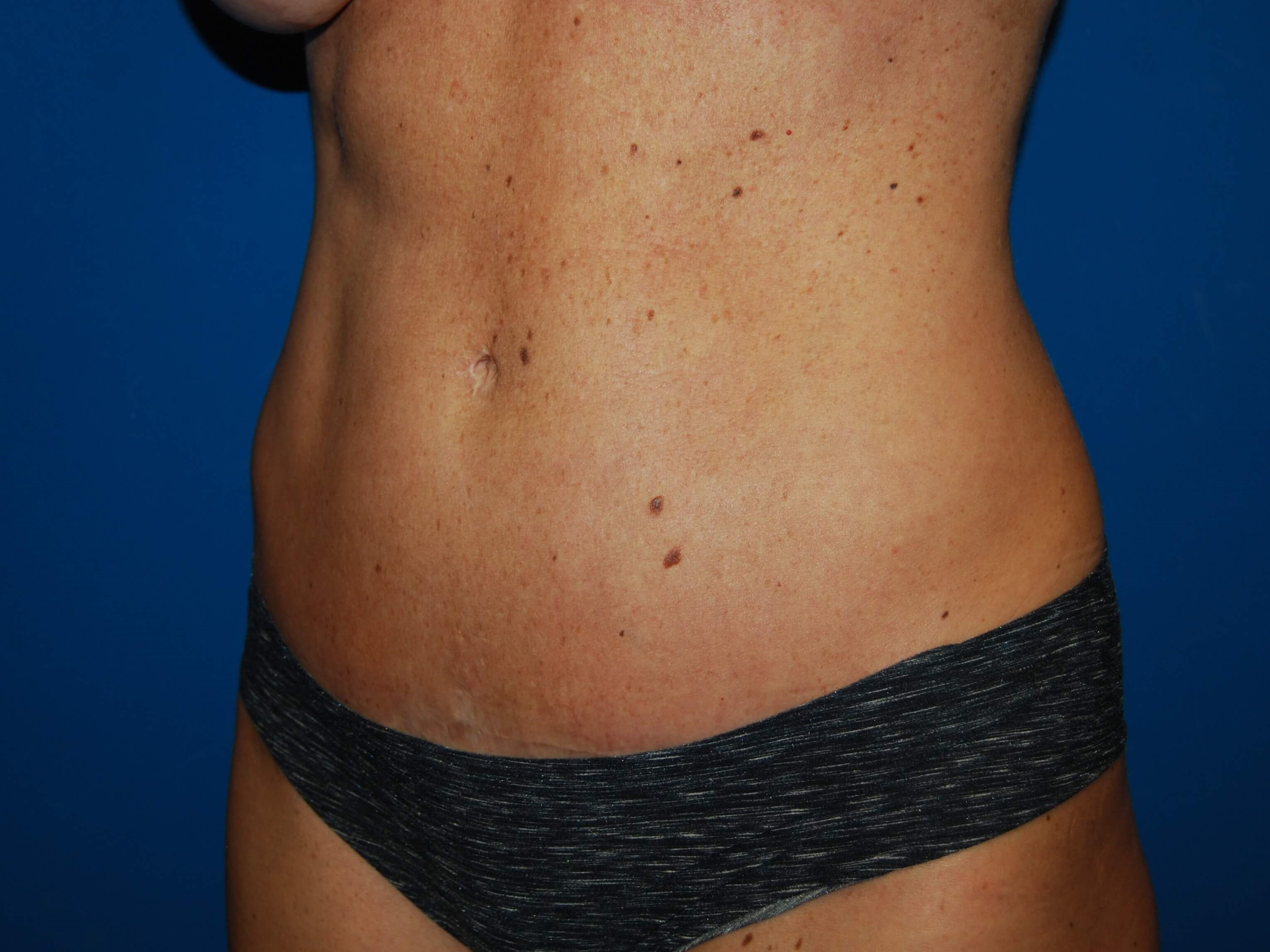 Oblique - Left After