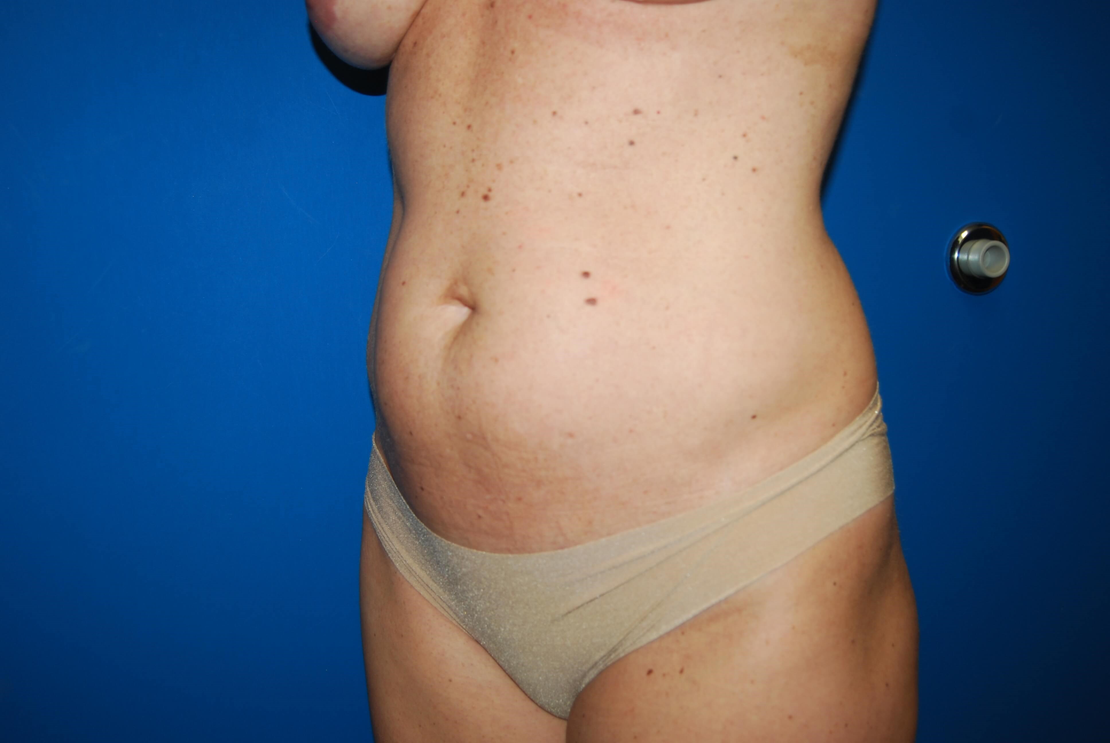 Oblique - Left Before