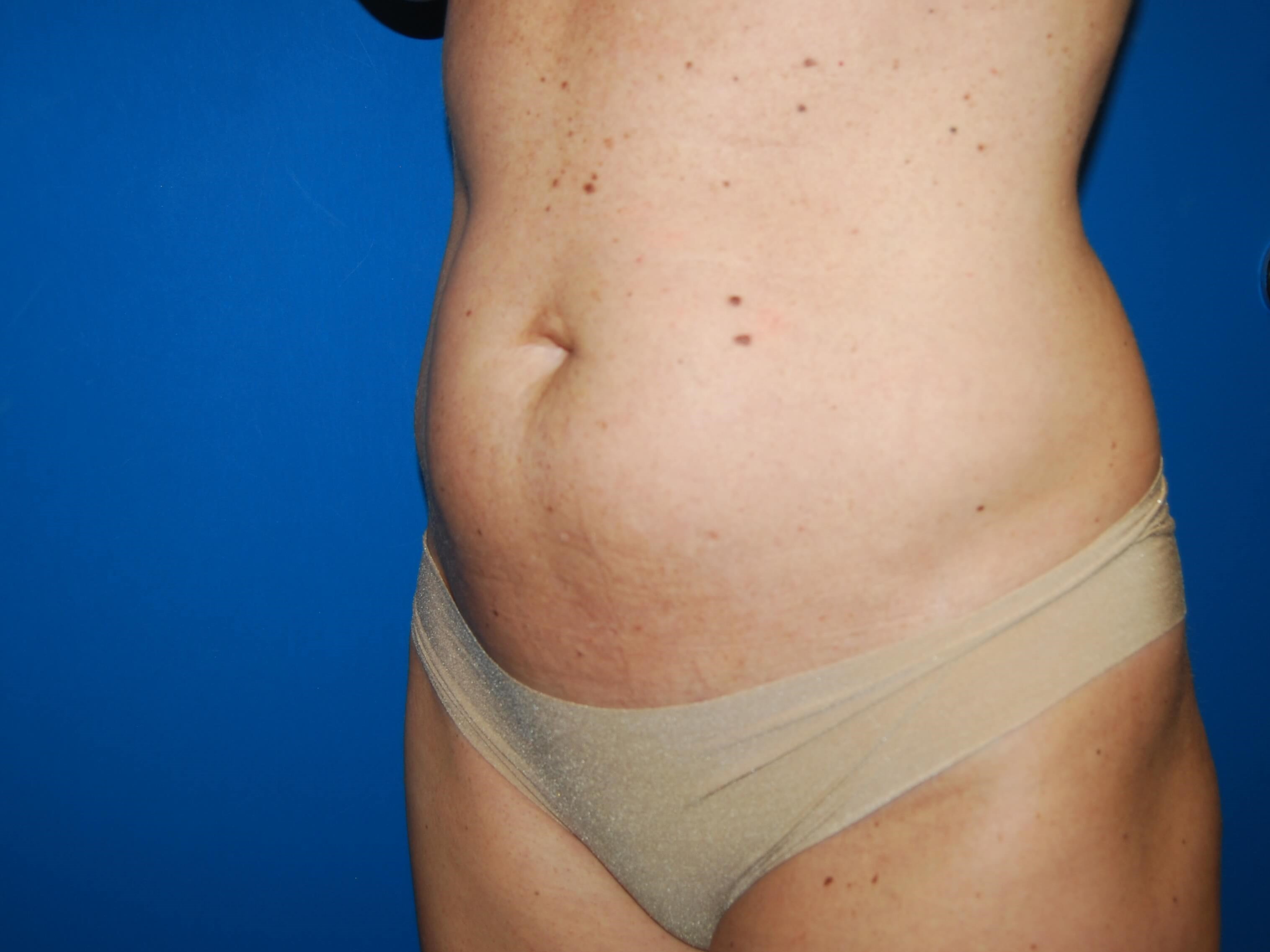 Oblique - Left Before