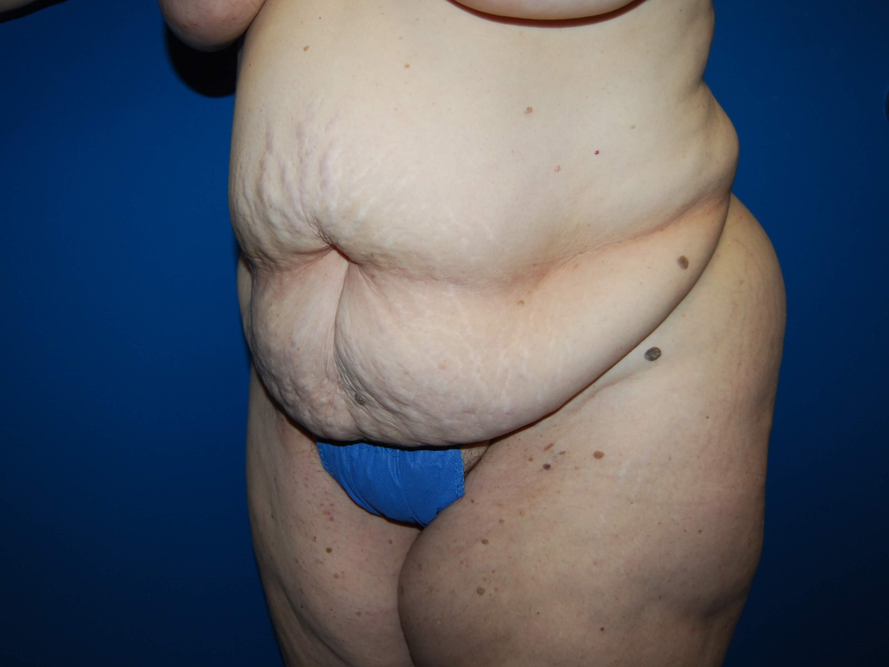 Oblique - Left Before