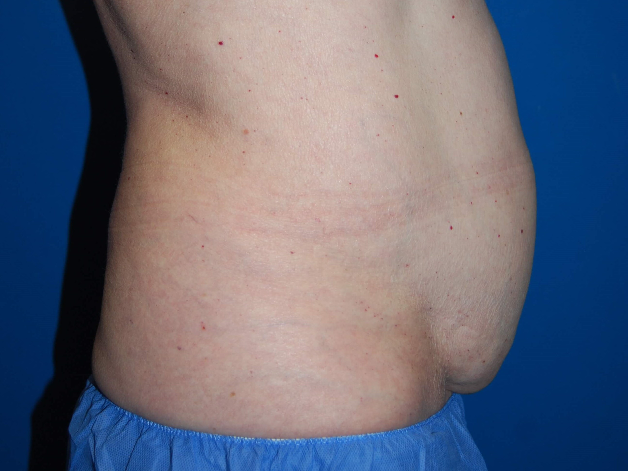 Coolsculting Abdomen/Flanks After Coolsculpting