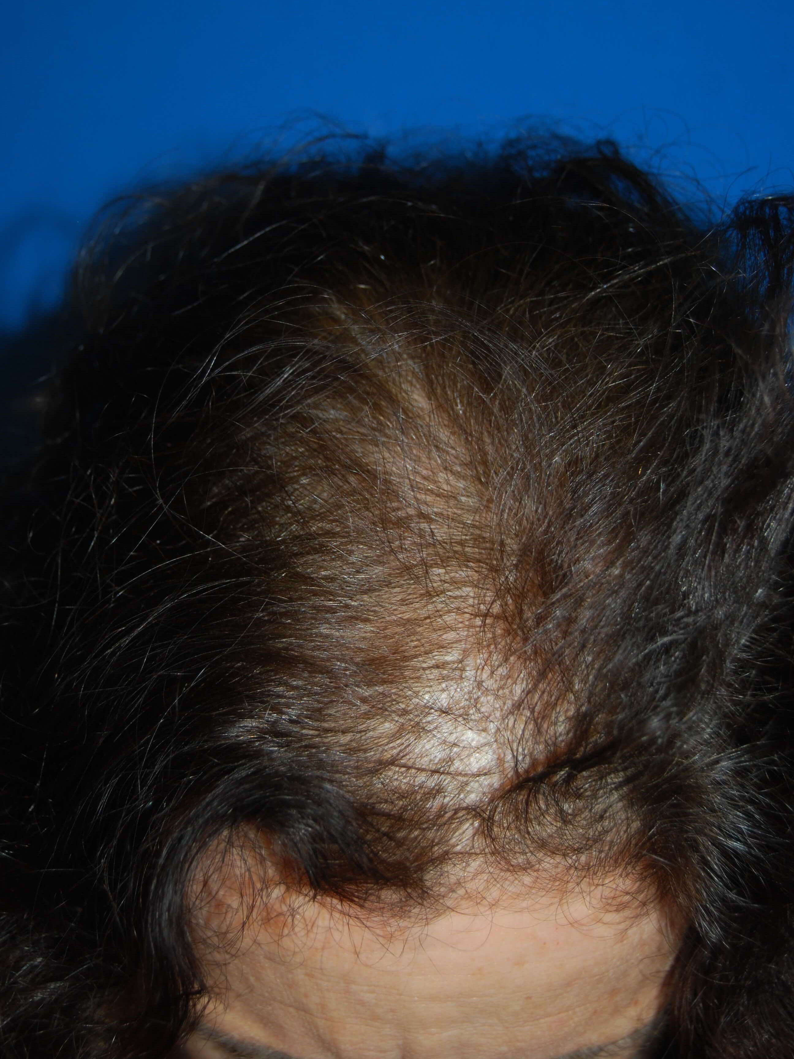 Front View Before Hair Transplant