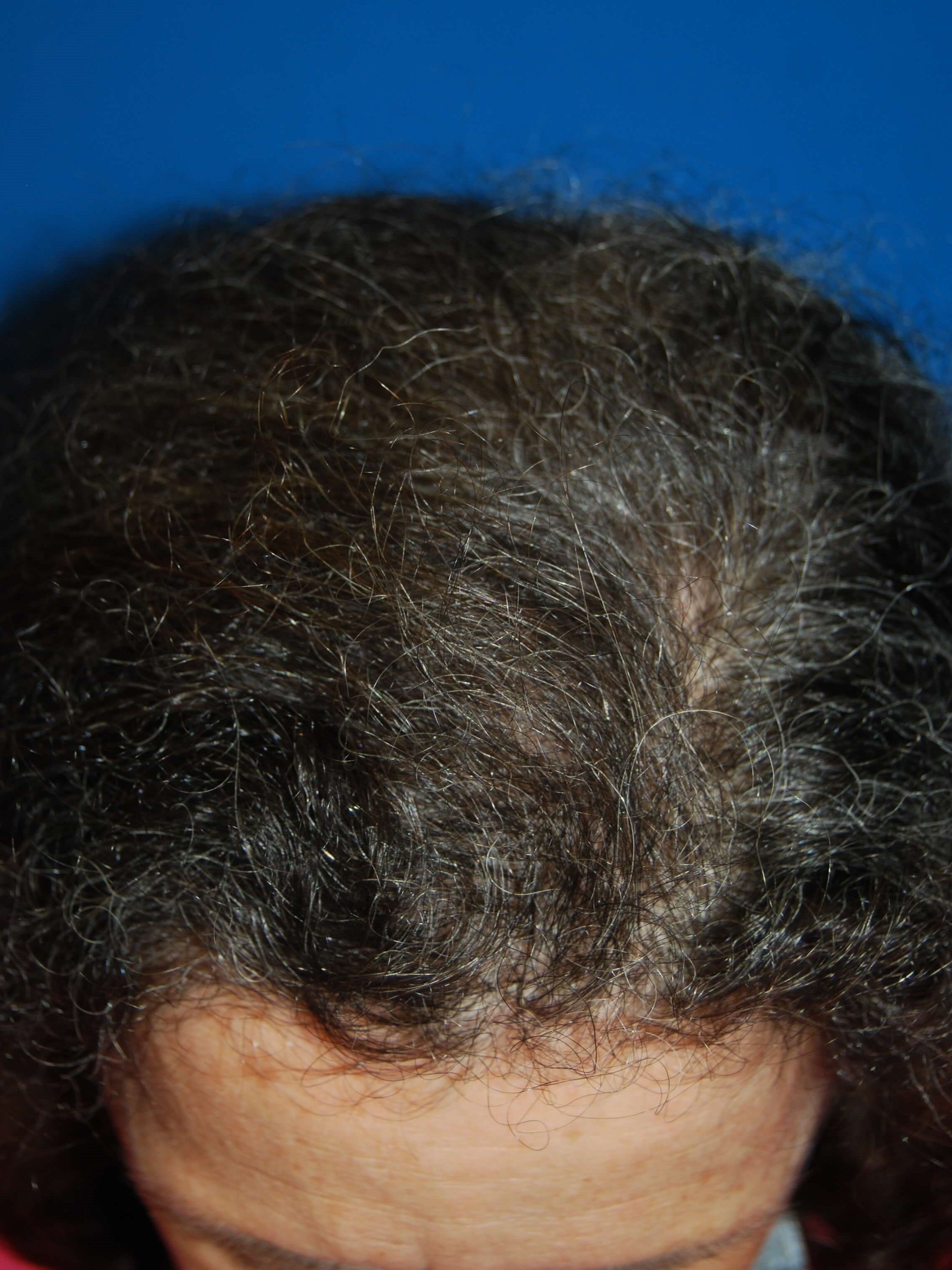 Front View After Hair Transplant