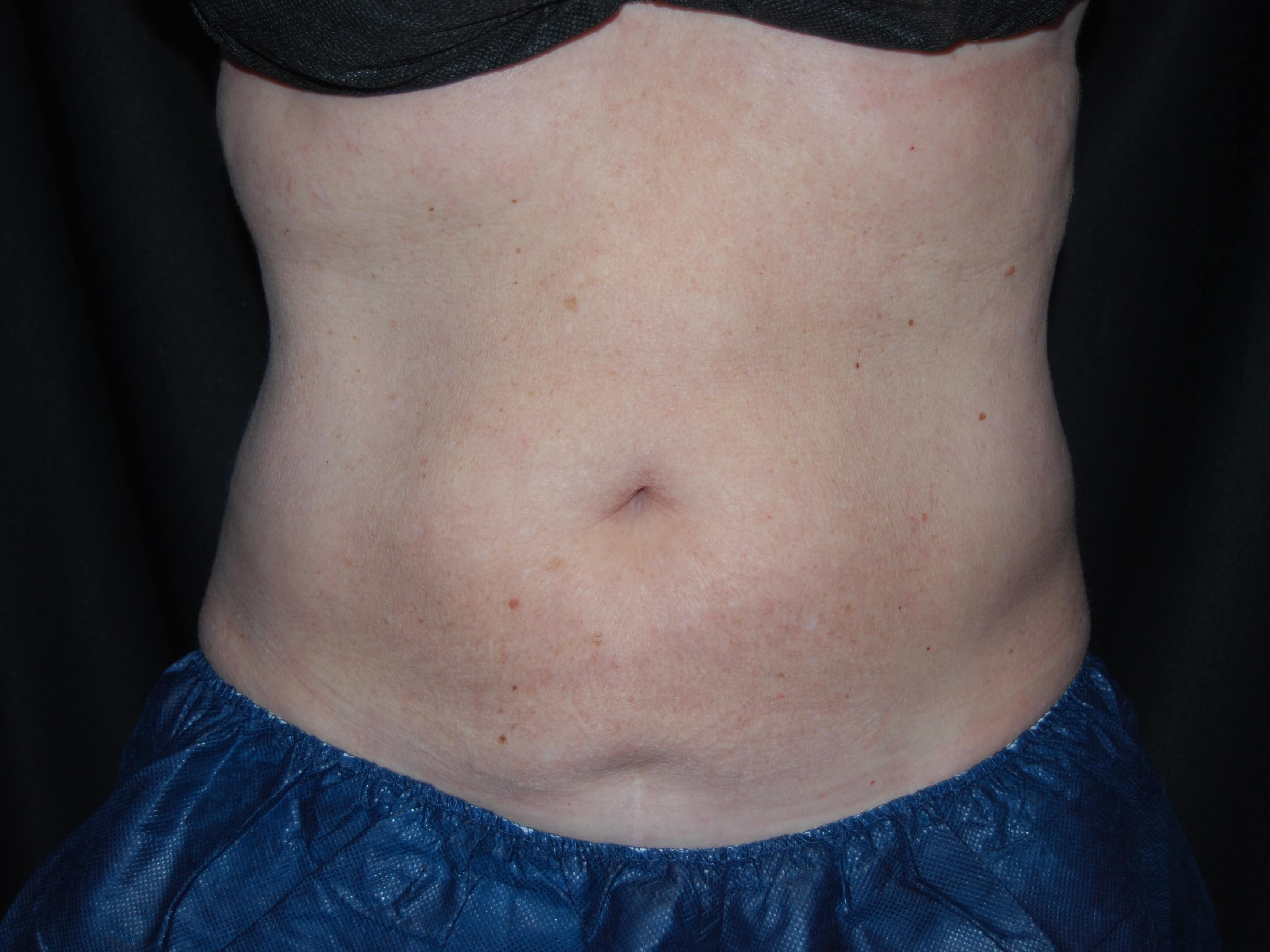 Coolsculpting Front View After - Abdomen