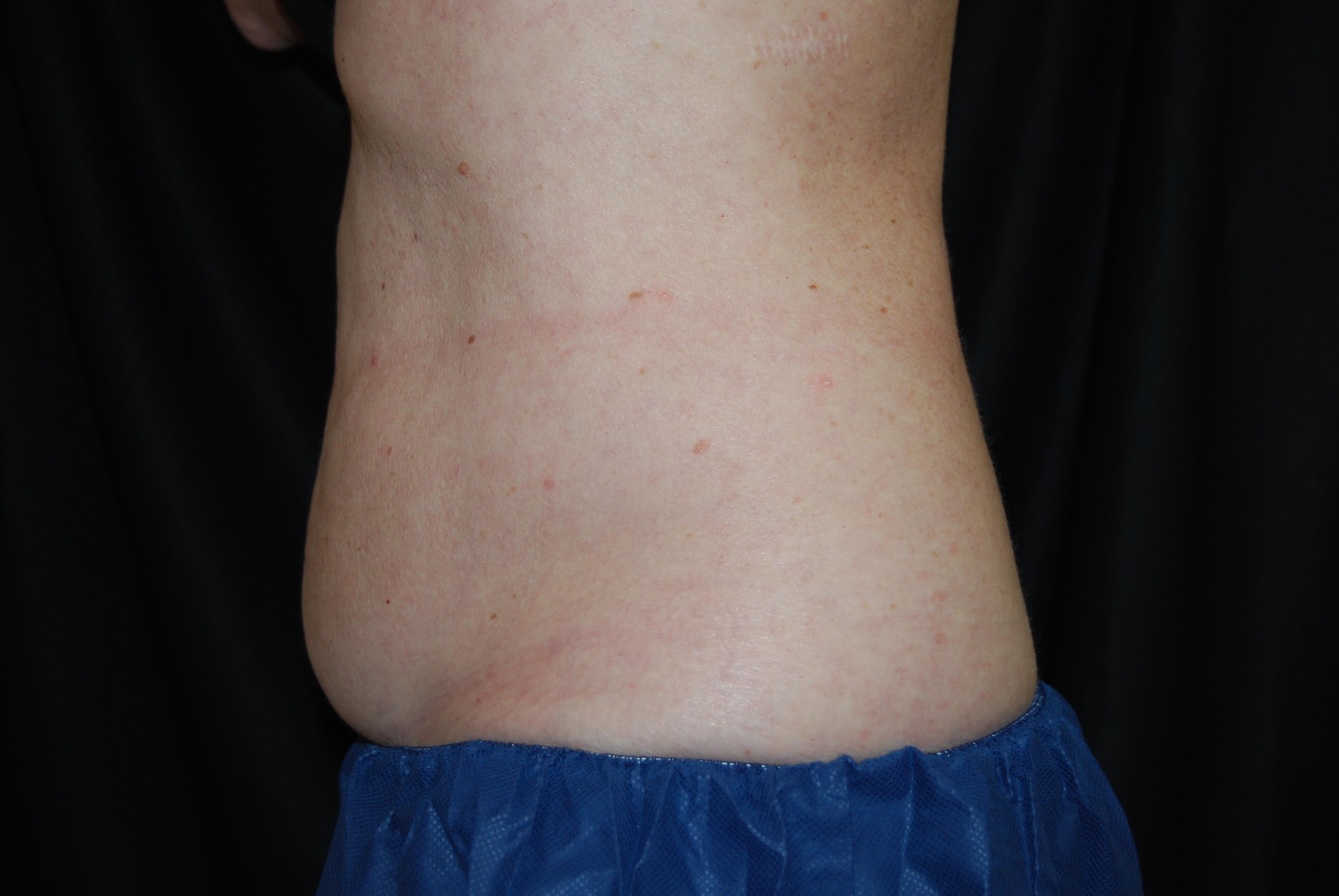 Coolsculpting Side View Before - Abdomen