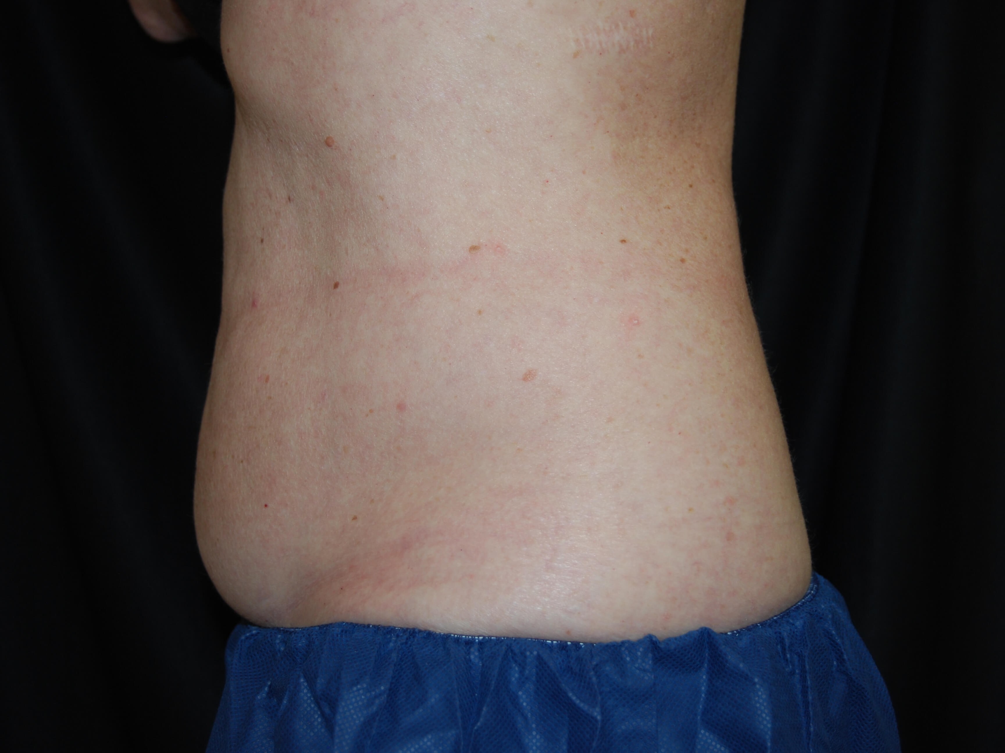 Coolsculpting Side View Before - Abdomen