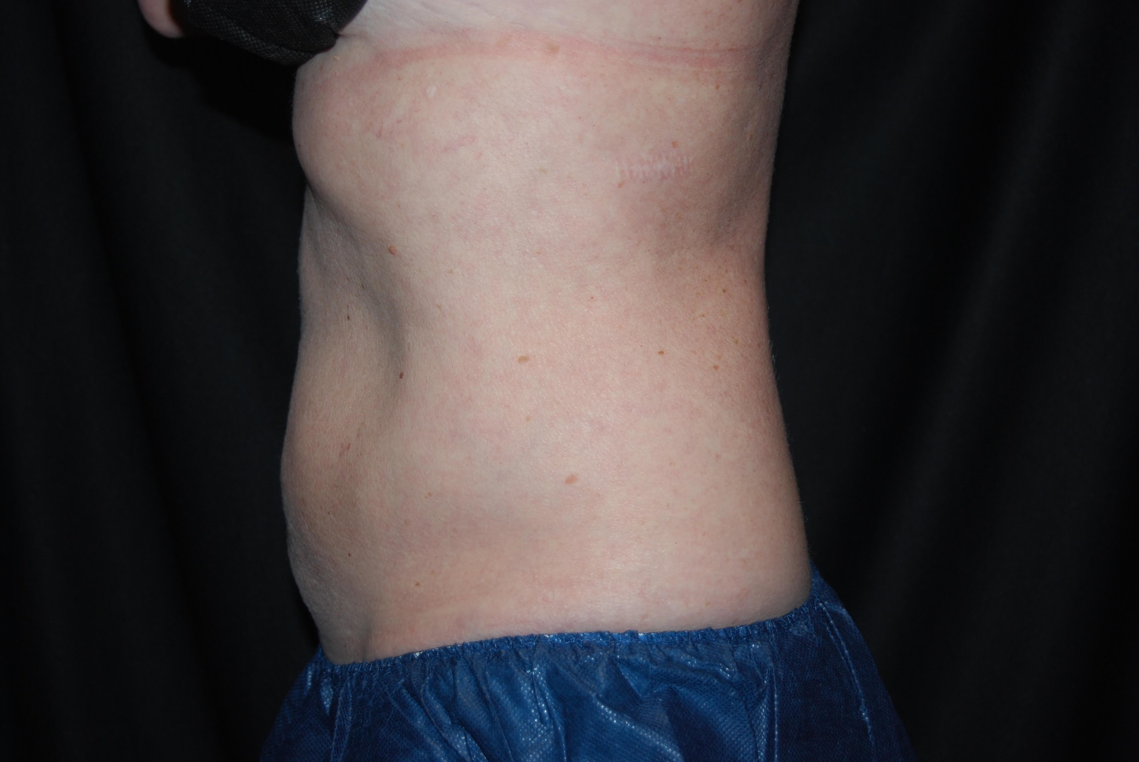 Coolsculpting Side View After - Abdomen