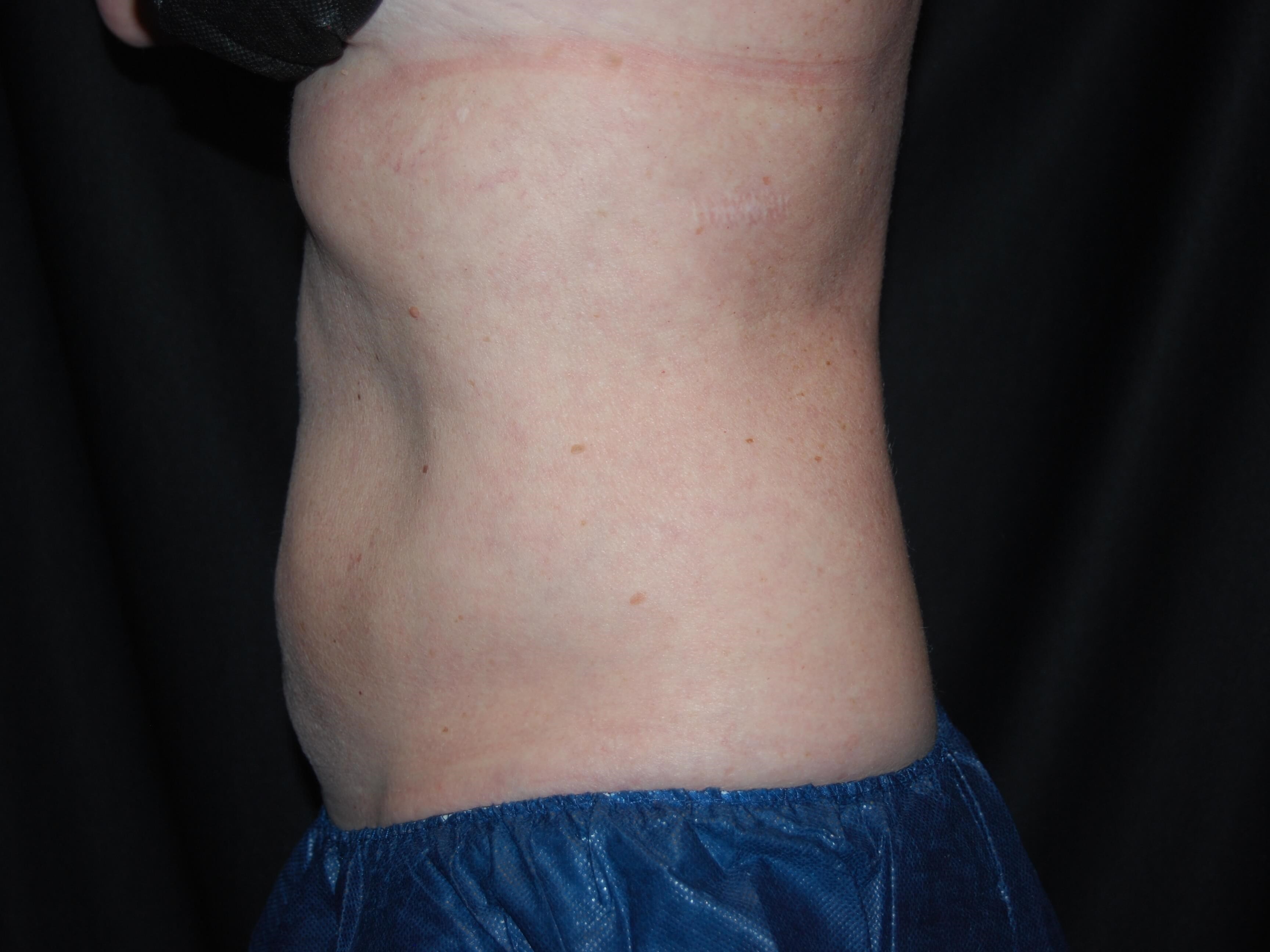 Coolsculpting Side View After - Abdomen