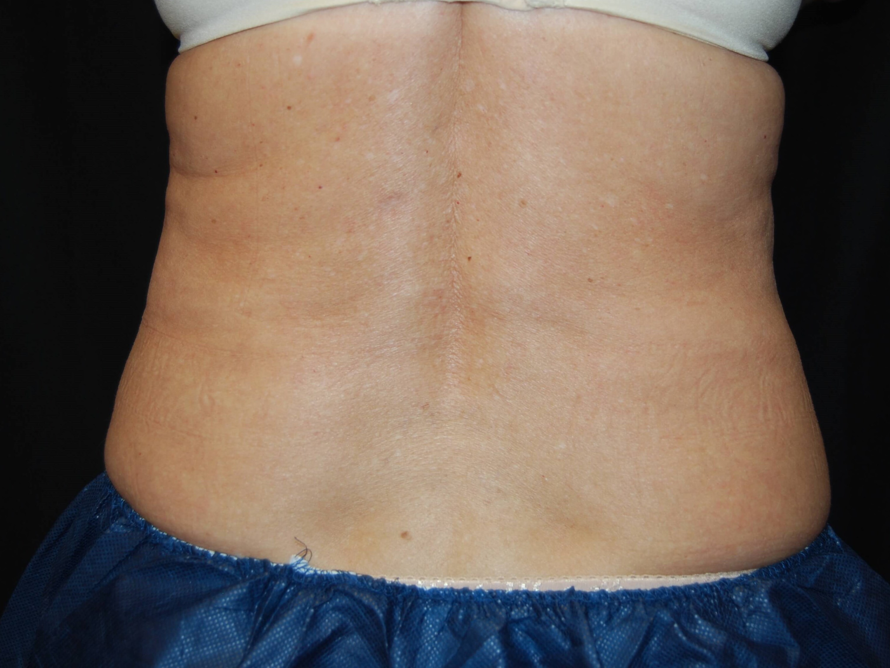 Back View After Coolsculpting