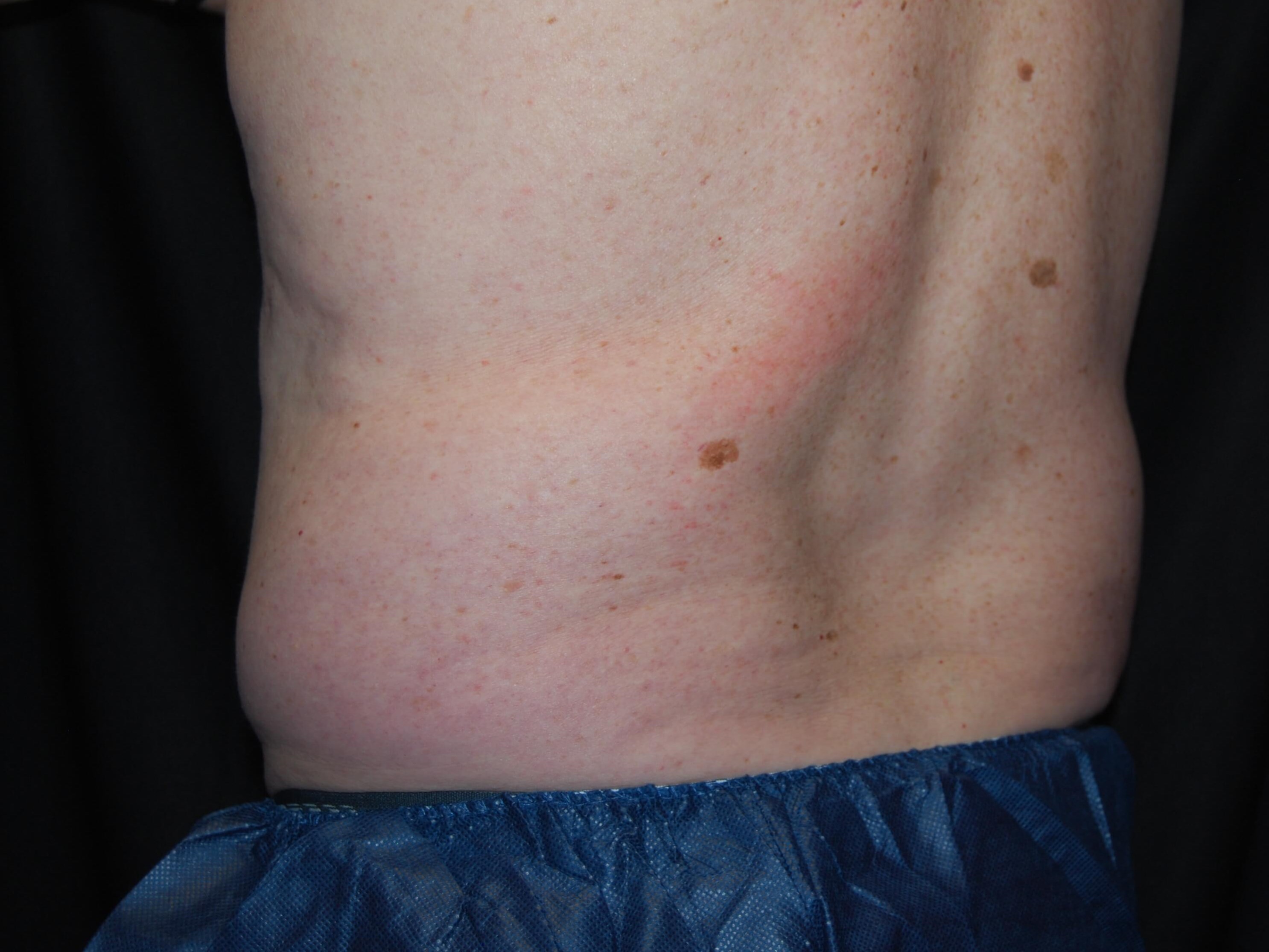 Left Side View - Flank After Coolsculpting