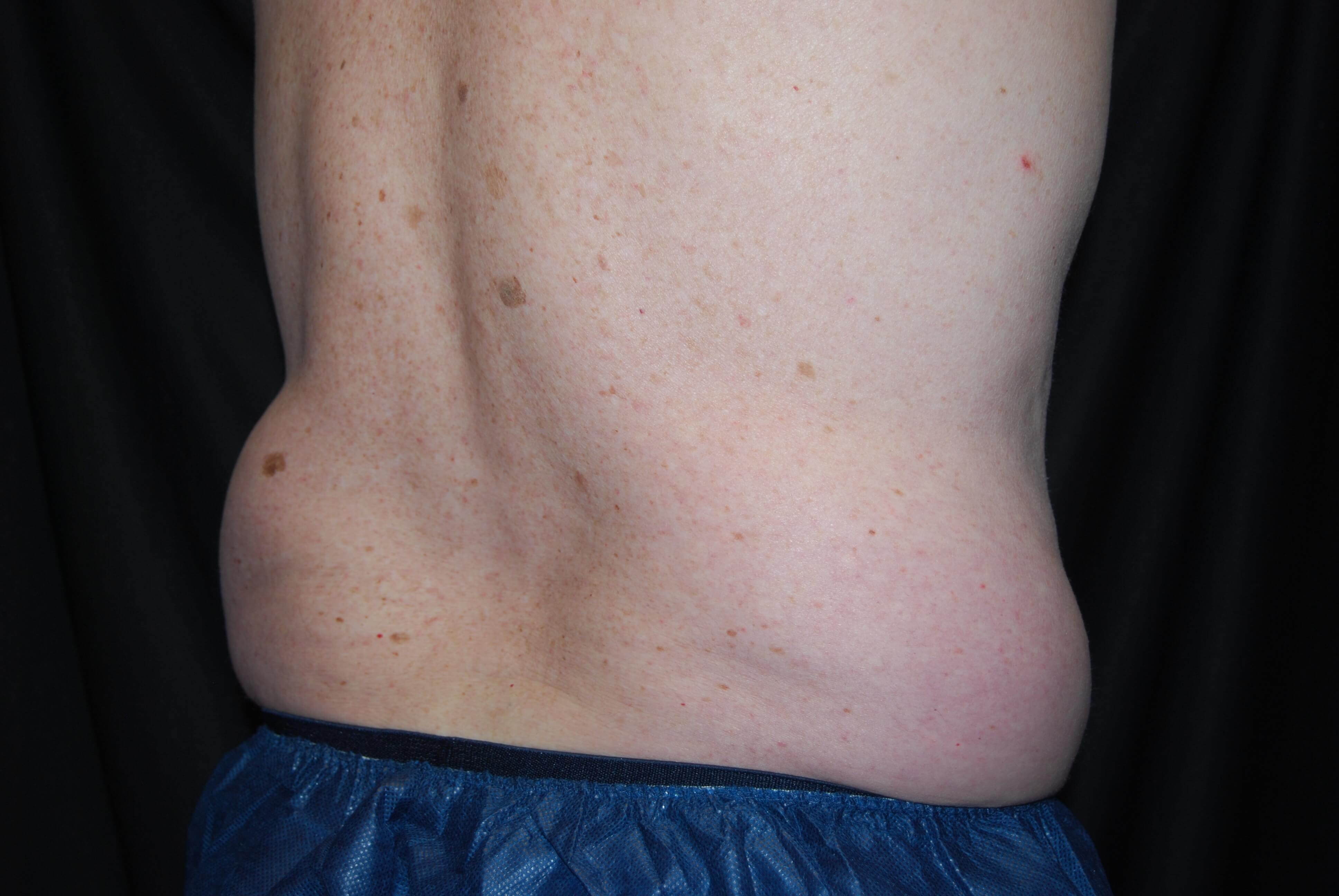 Right Side View - Flank Before Coolsculpting